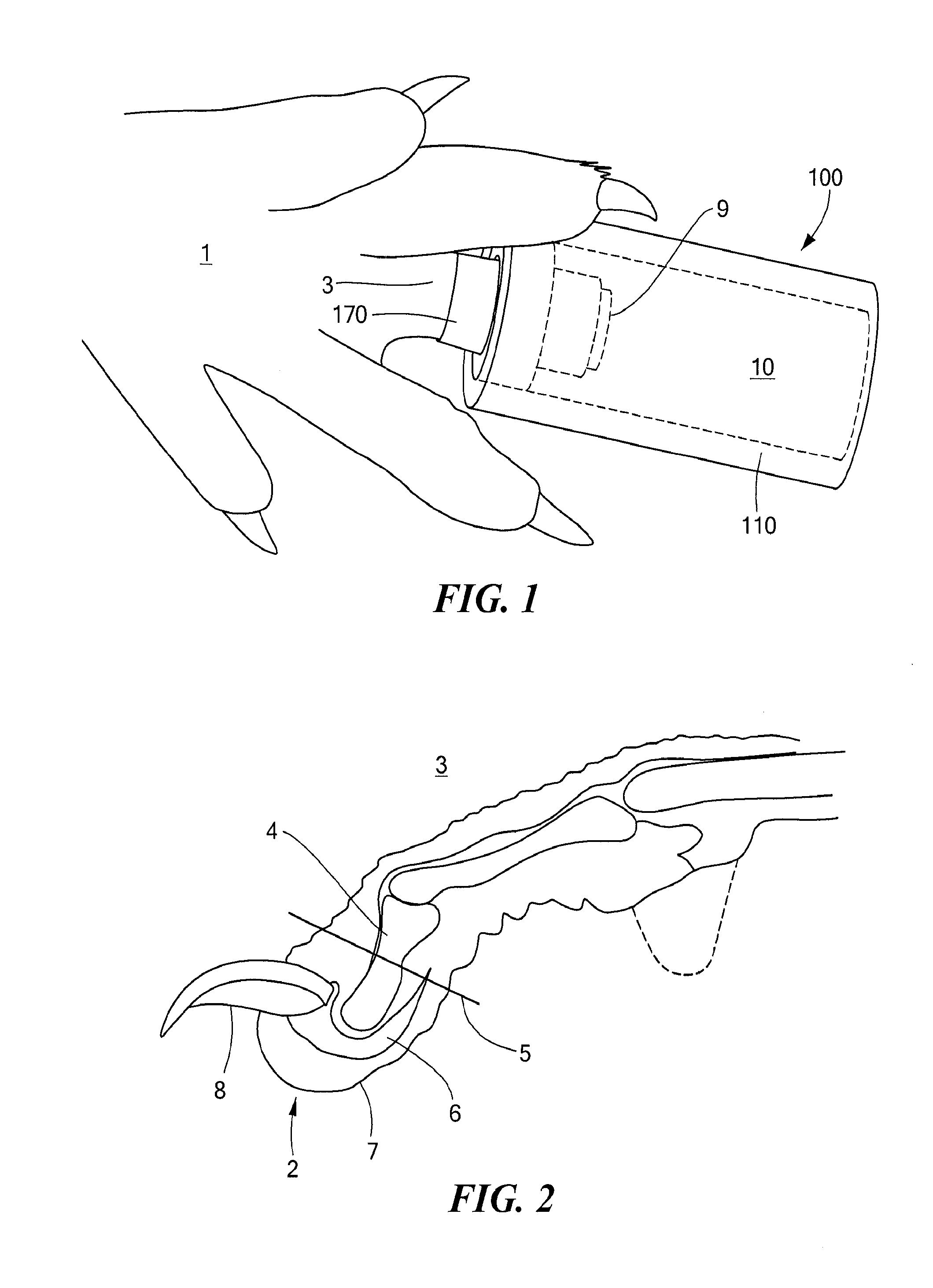 Sleeve for stimulation of tissue regeneration