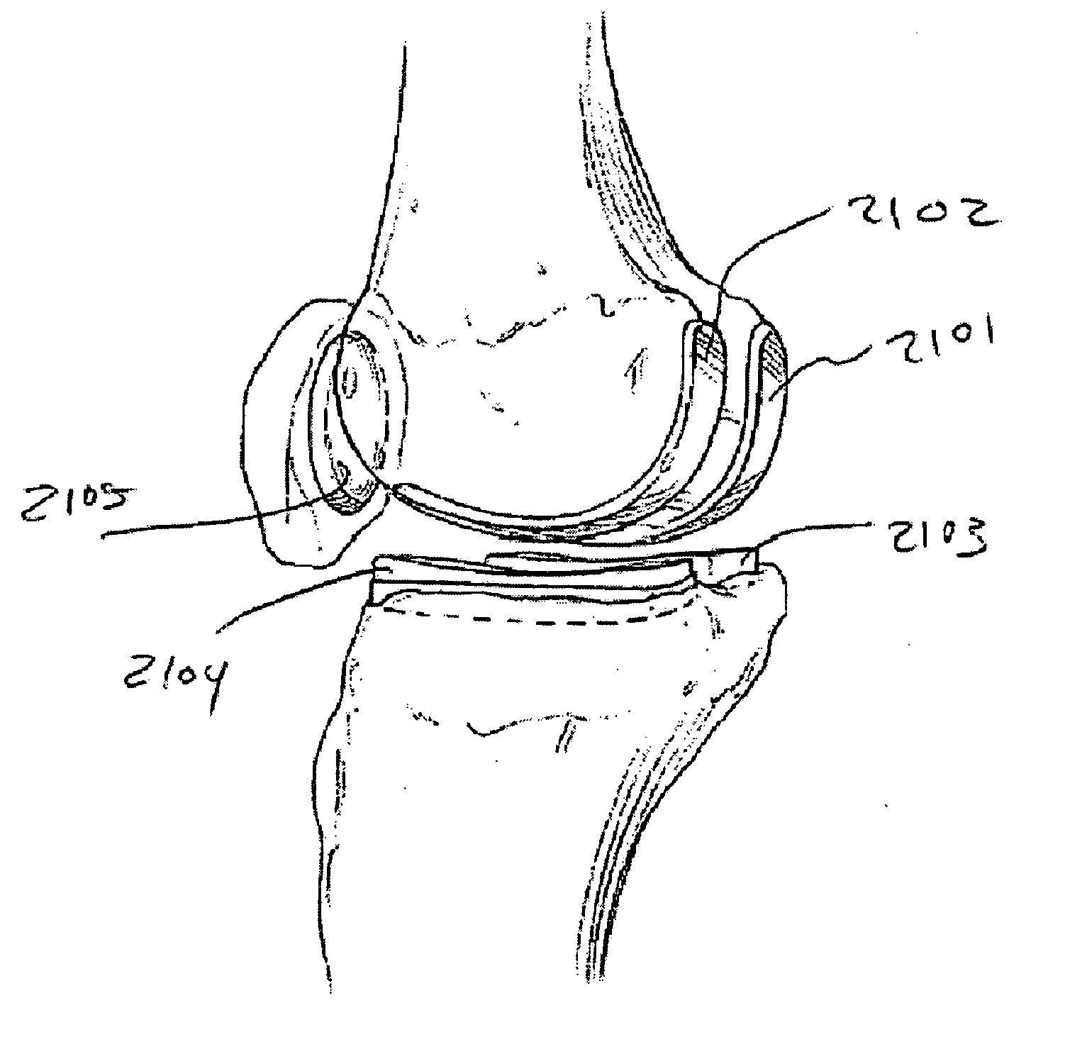 Modular apparatus and method for sculpting the surface of a joint
