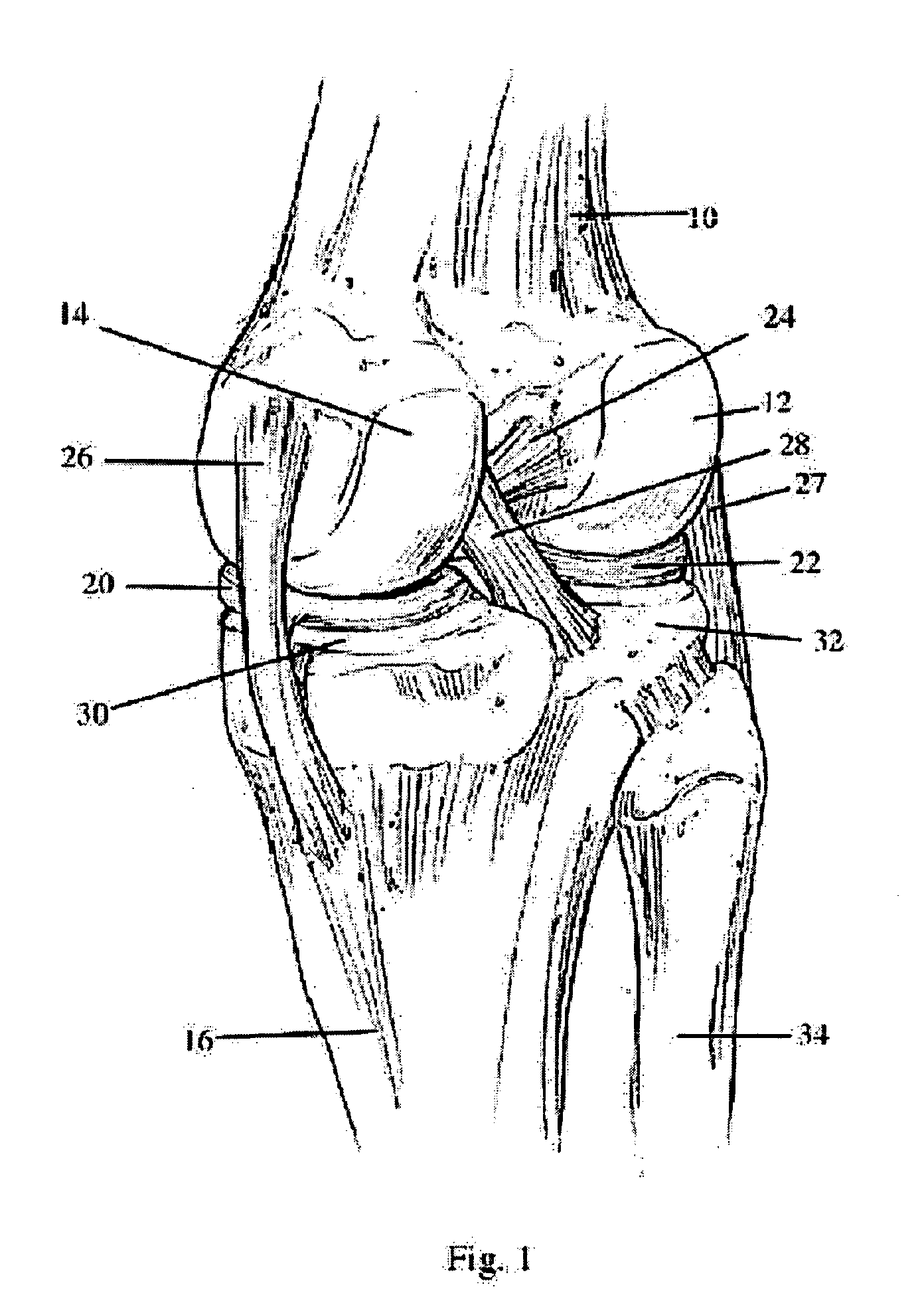 Modular apparatus and method for sculpting the surface of a joint