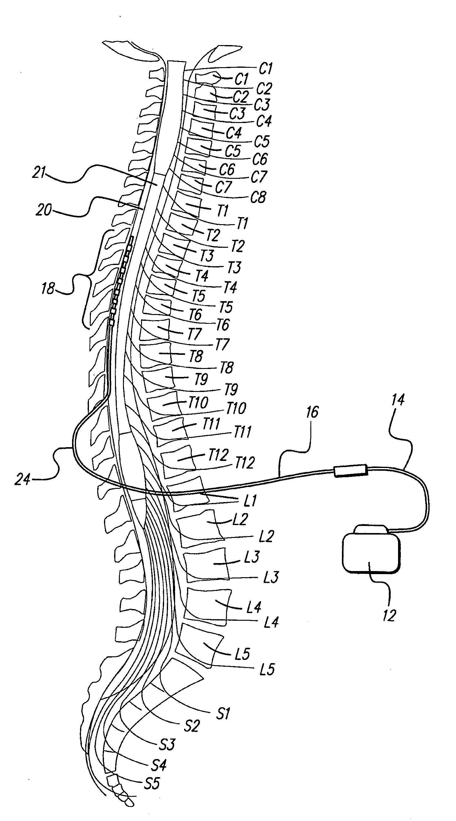 Method for optimizing search for spinal cord stimulation parameter setting