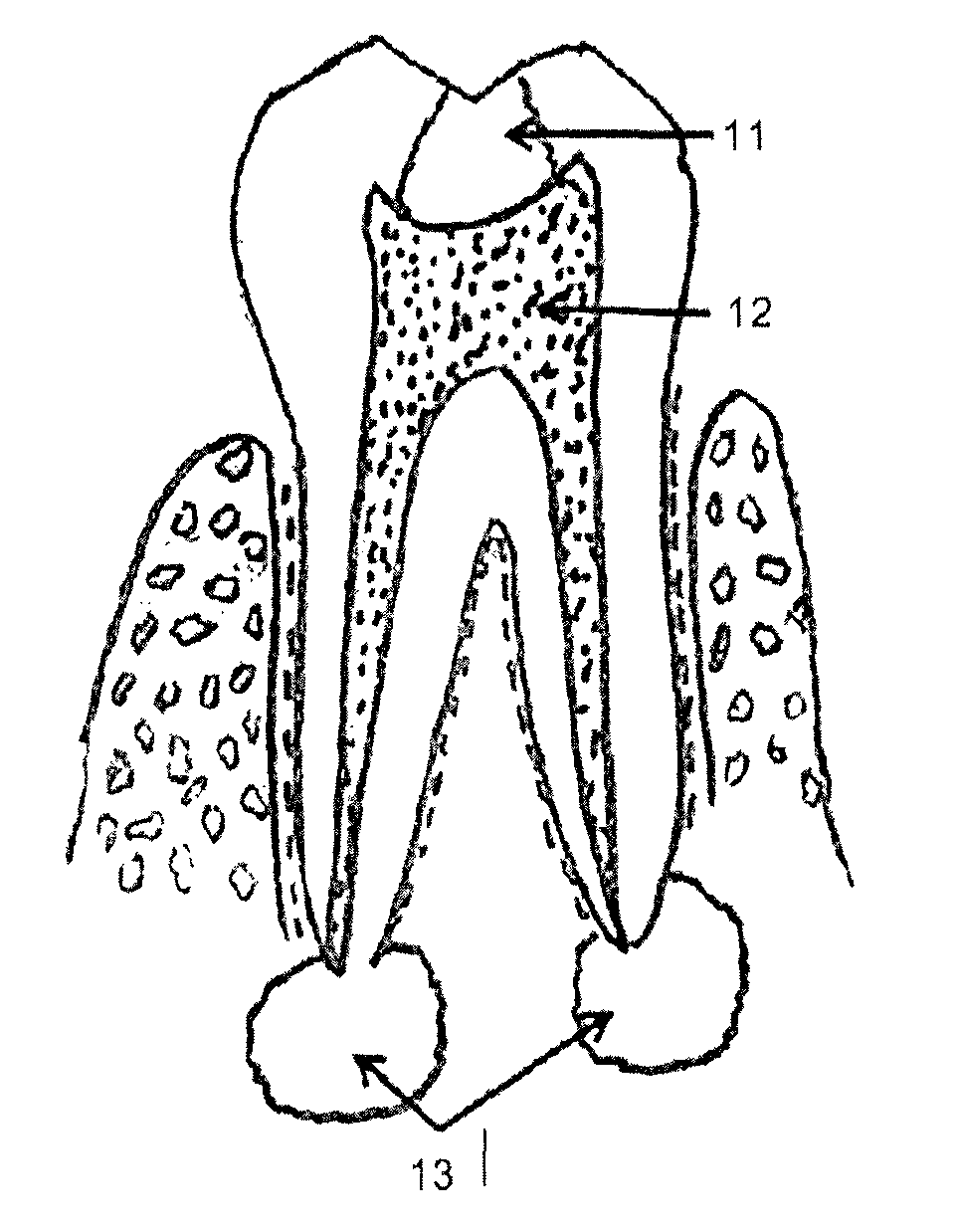 Sealbio: a novel non-obturation regenerative technique of endodontic treatment