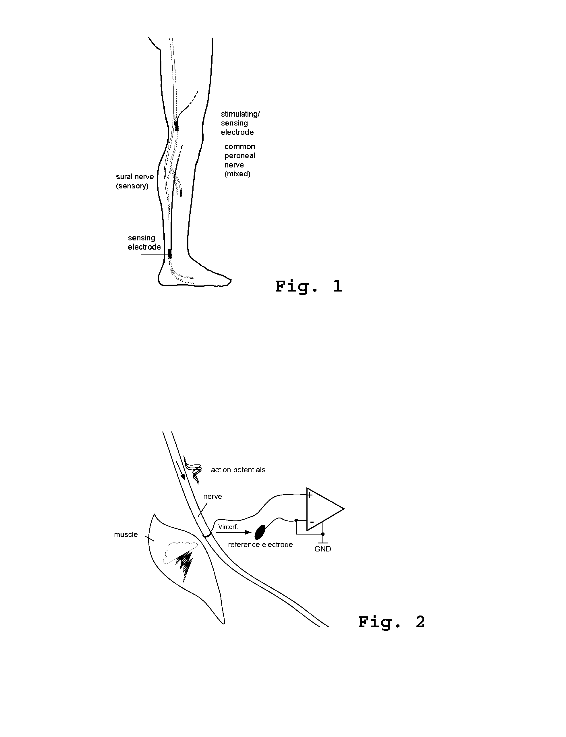 System for recording electroneurographic activity