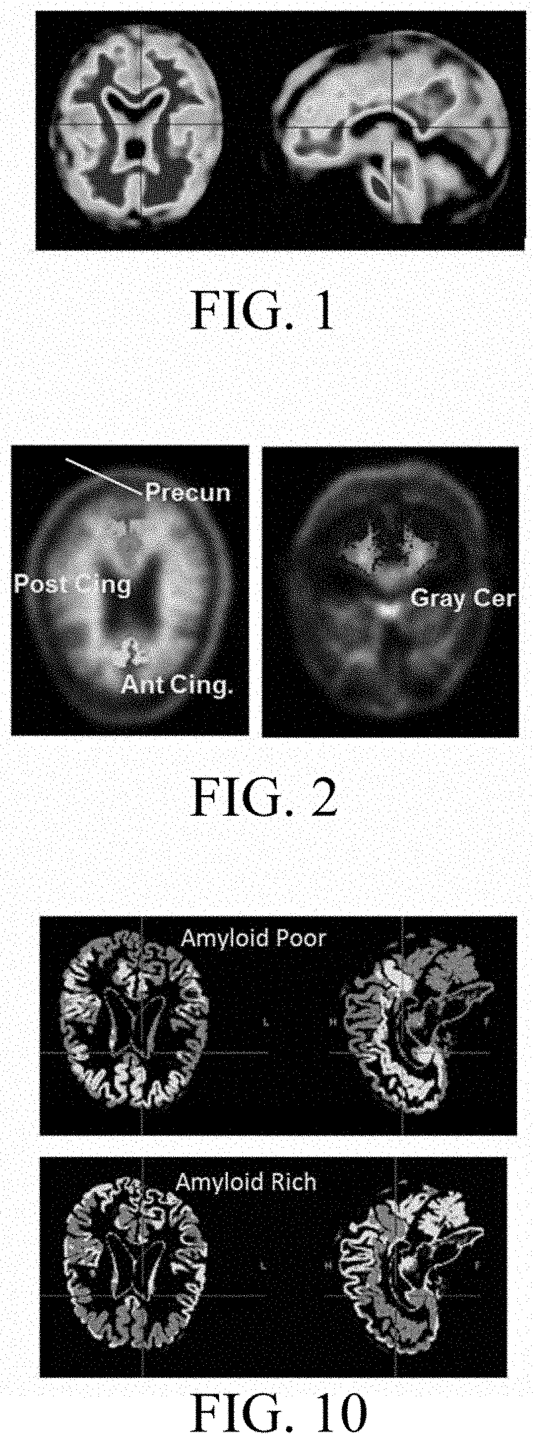 Method for analyzing and correcting measurement variability in pet images