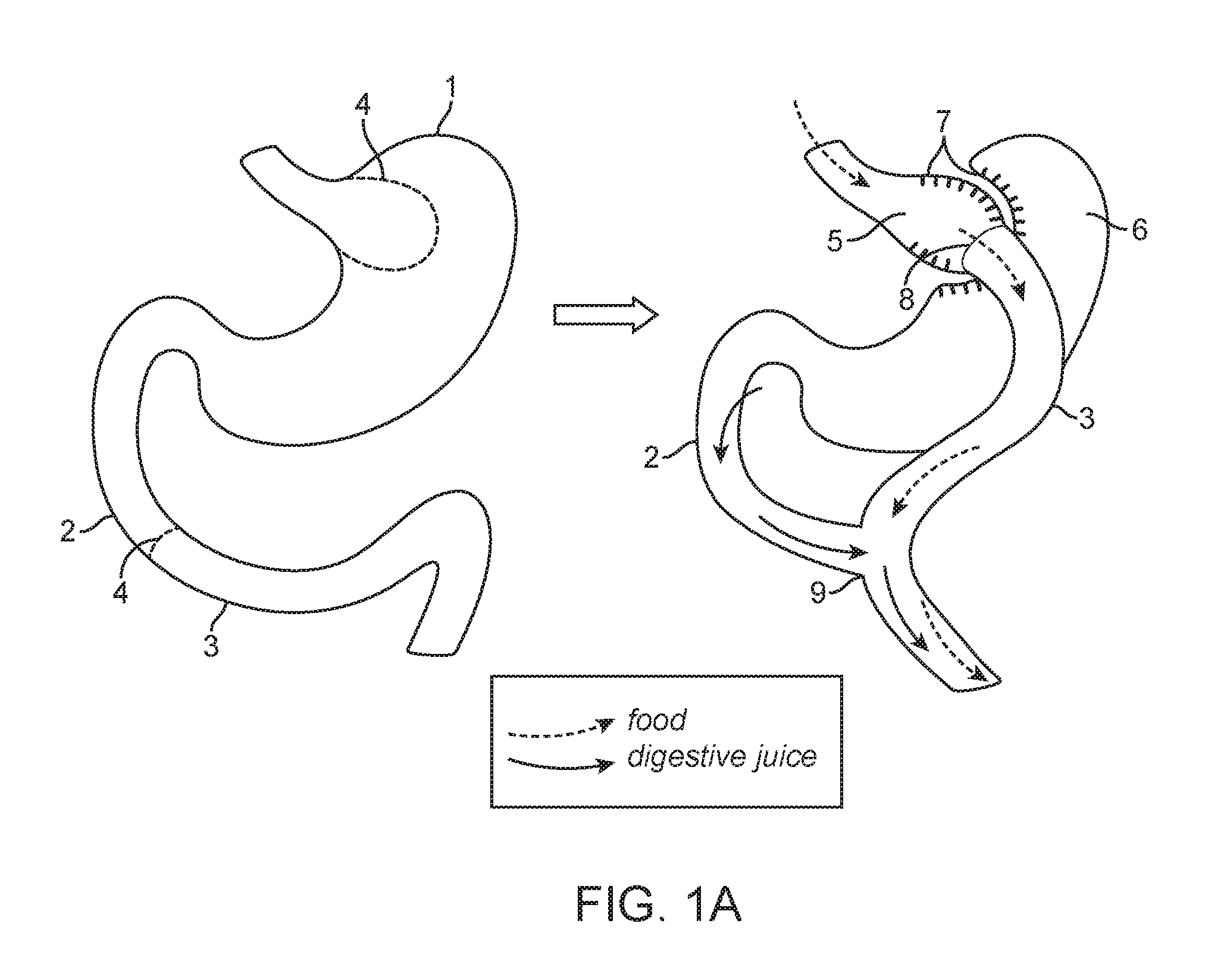 Devices and methods for forming an anastomosis