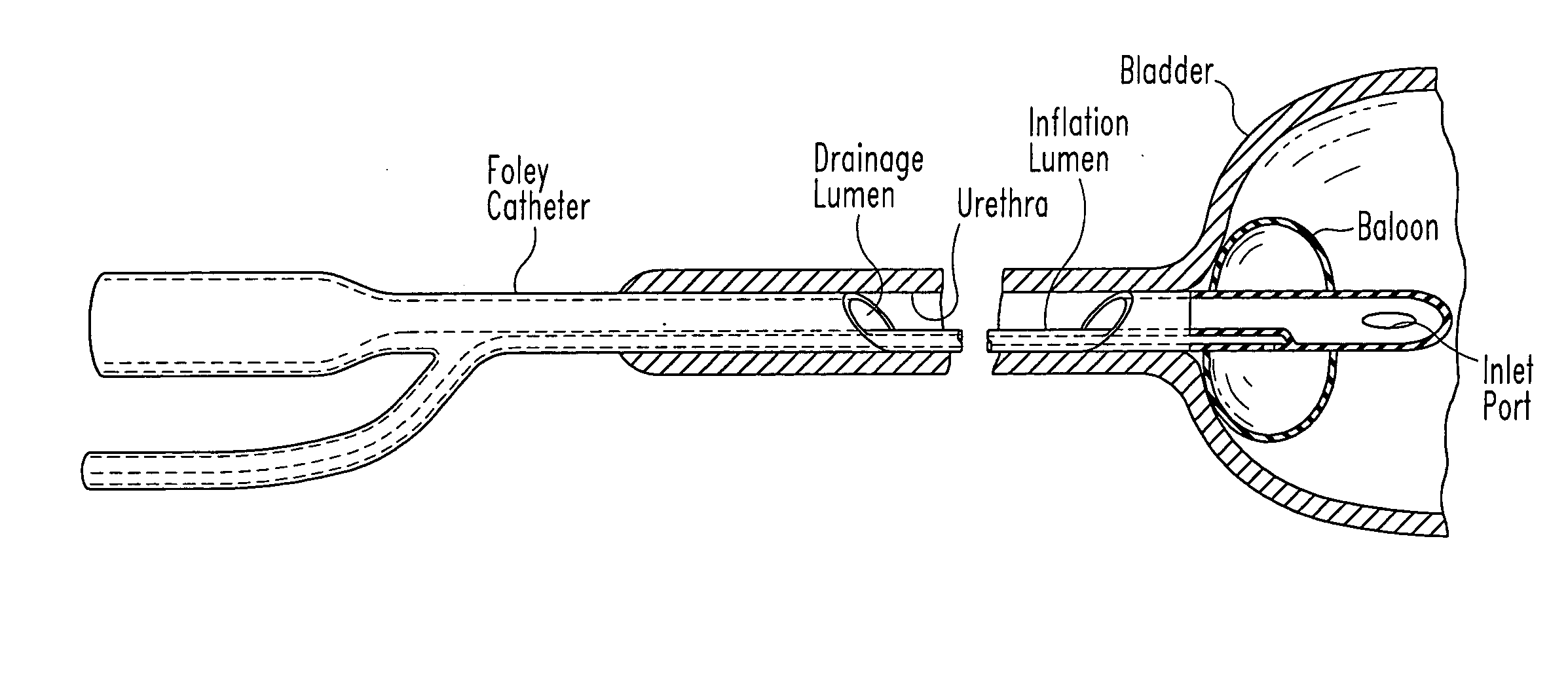 Self-Cleansing Bladder Drainage Catheter