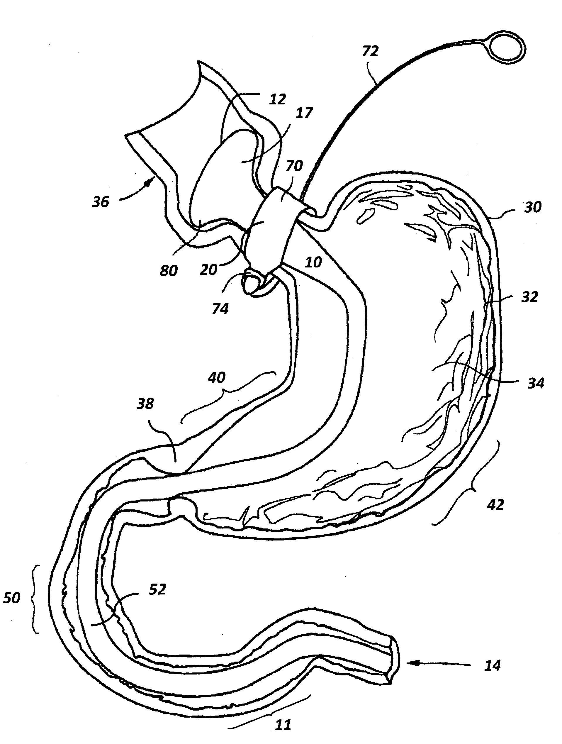 Devices and methods for augmenting extragastric banding