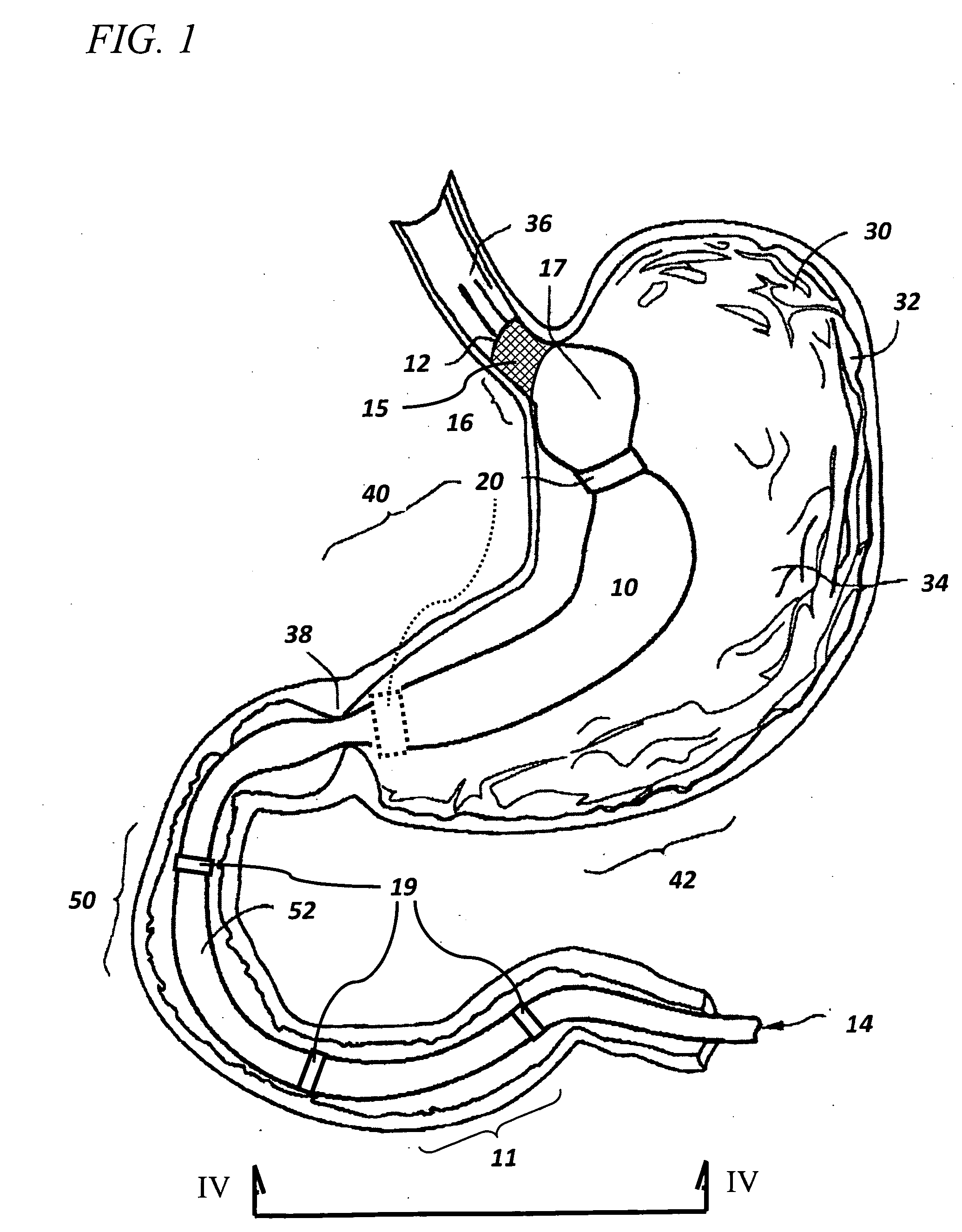 Devices and methods for augmenting extragastric banding