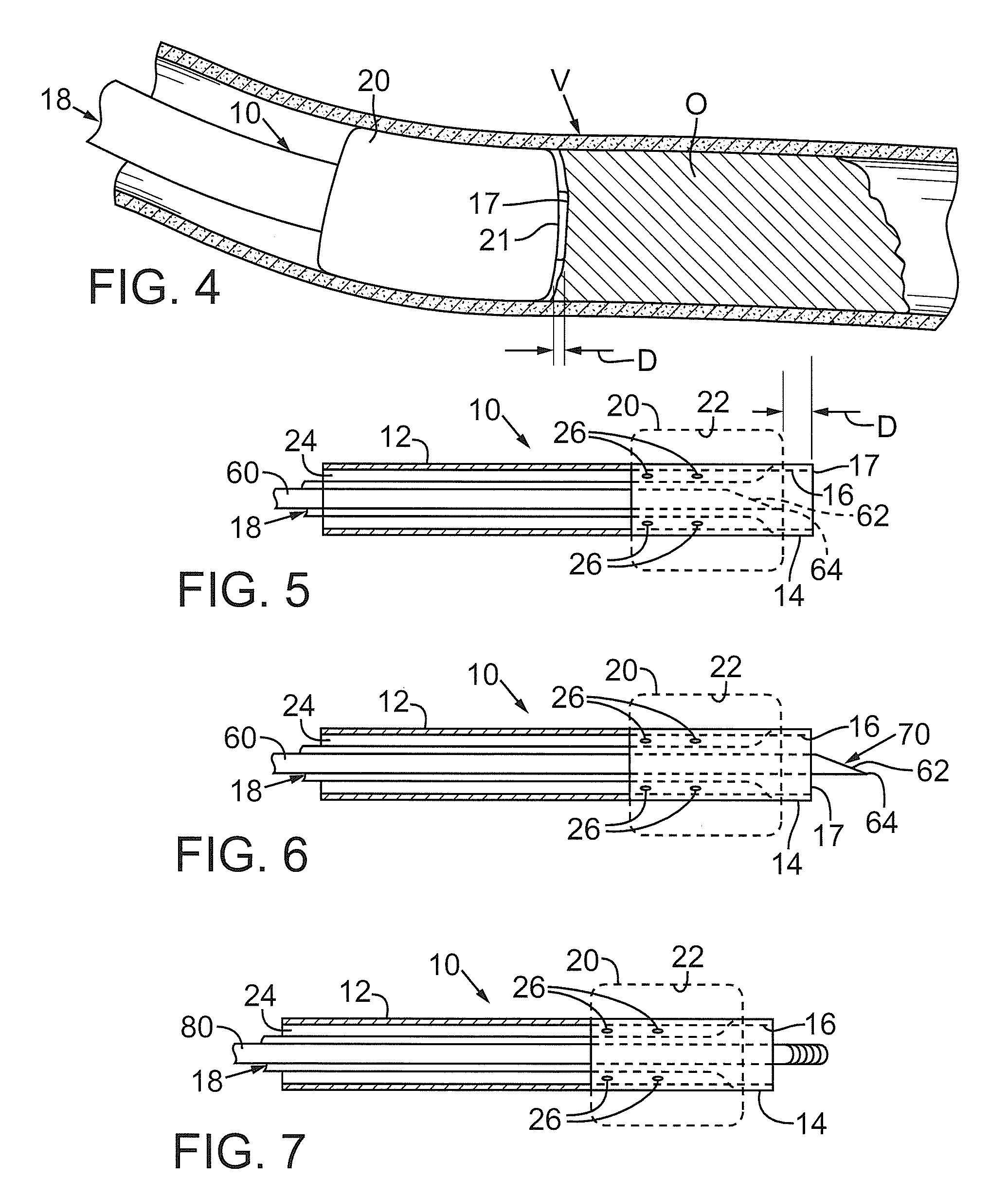 Devices and methods for treating chronic total occlusion