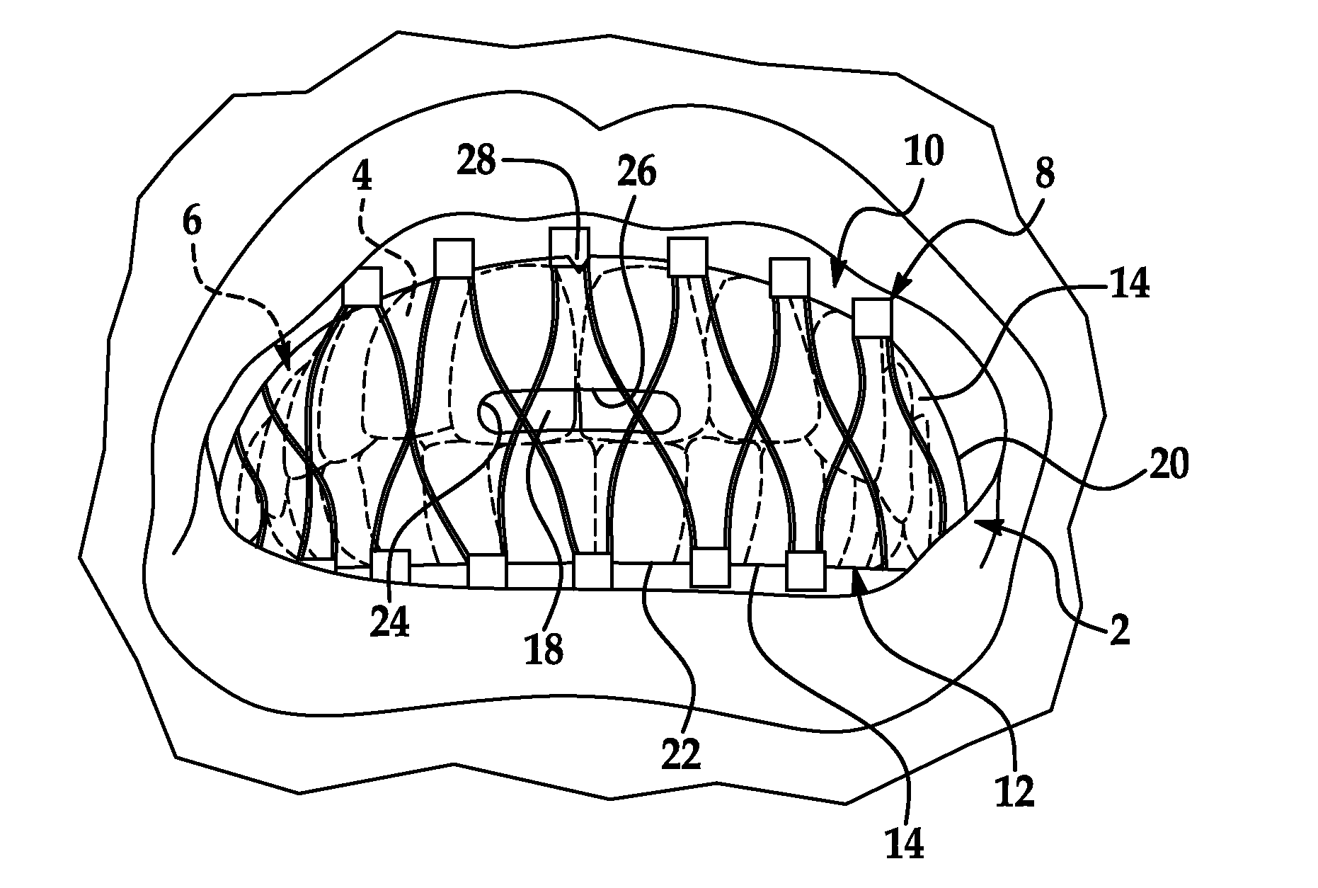 Wired-mouth-protection medical device