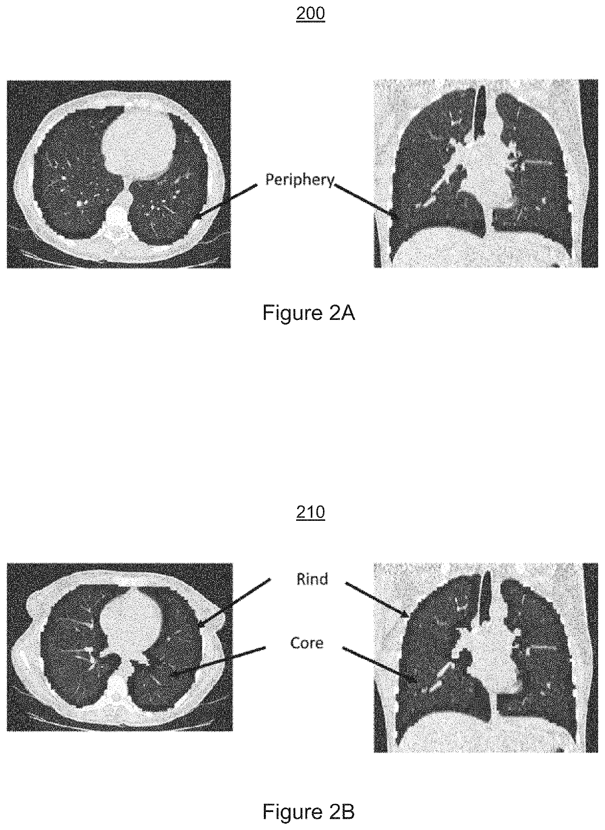 Automatic detection of covid-19 in chest ct images