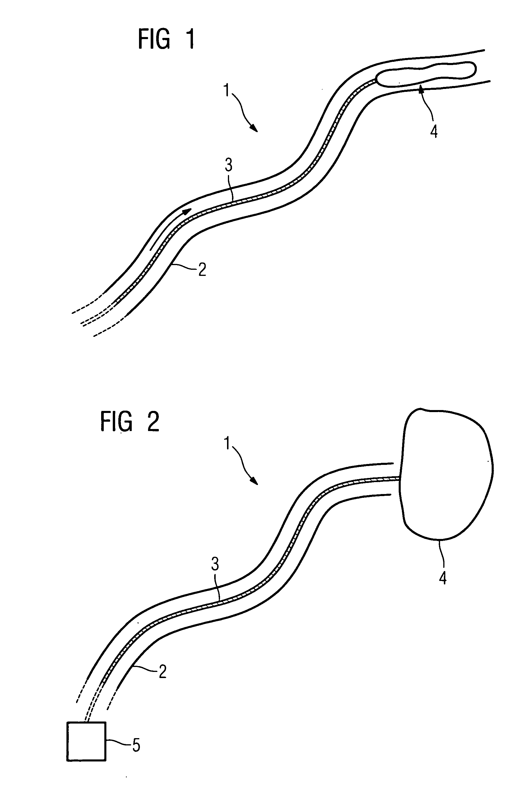 Ablation catheter for setting a lesion