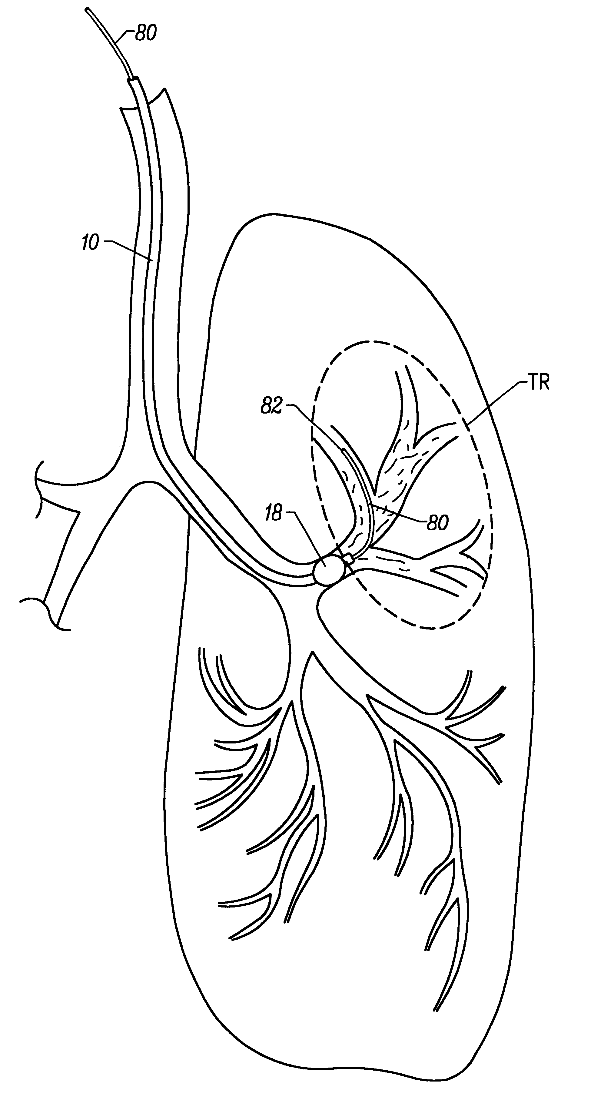 Apparatus and method for isolated lung access