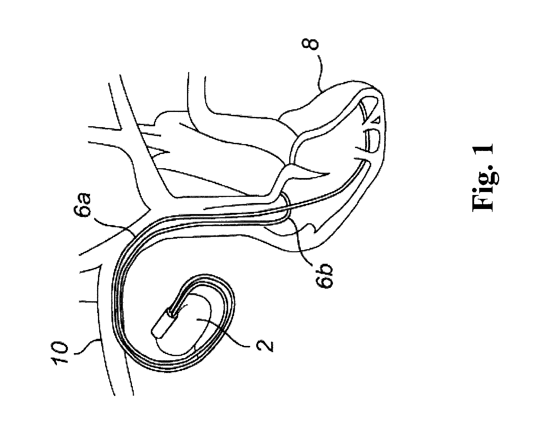 Dual chamber pacemaker