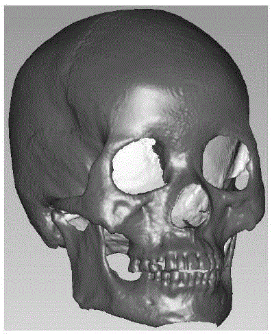 Craniofacial reconstruction method
