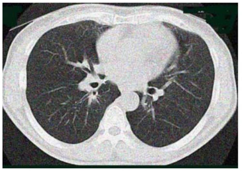 Chest model capable of being used for percutaneous pulmonary nodule puncture under guidance of CT imaging