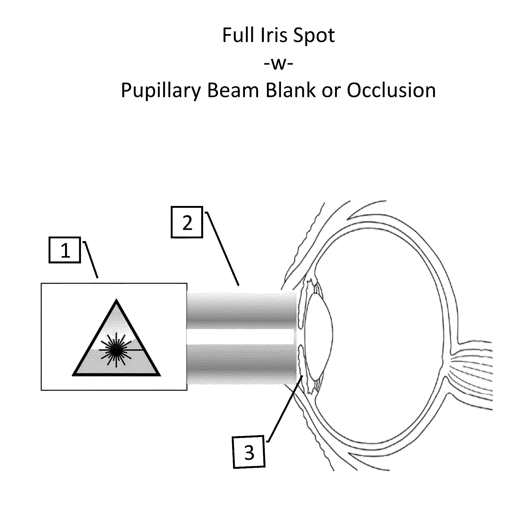 Method for Laser Treatment for Glaucoma