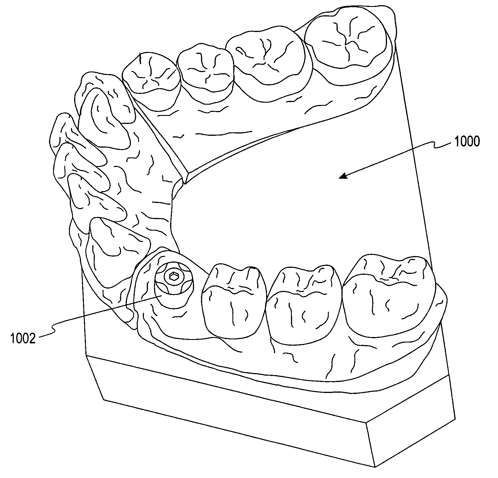 Methods for placing an implant analog in a physical model of the patient's mouth