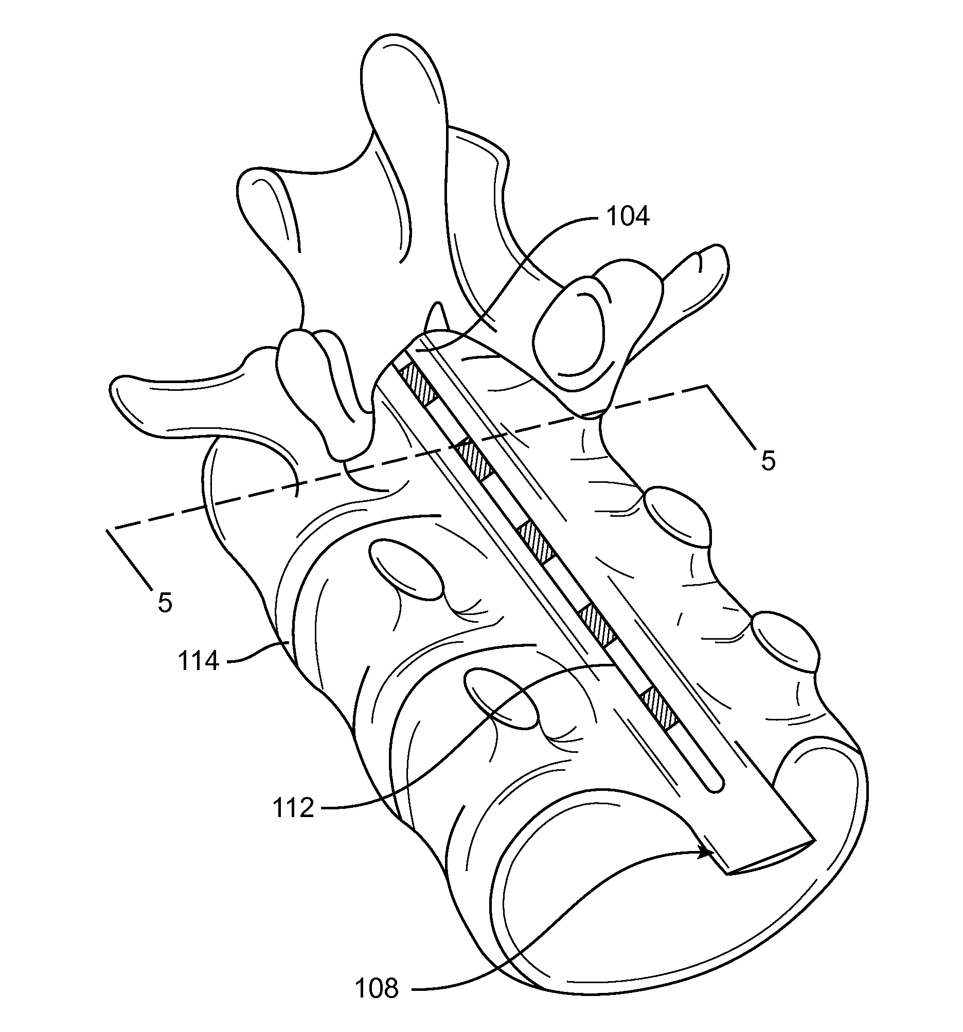 System and method for electrical modulation of the posterior longitudinal ligament