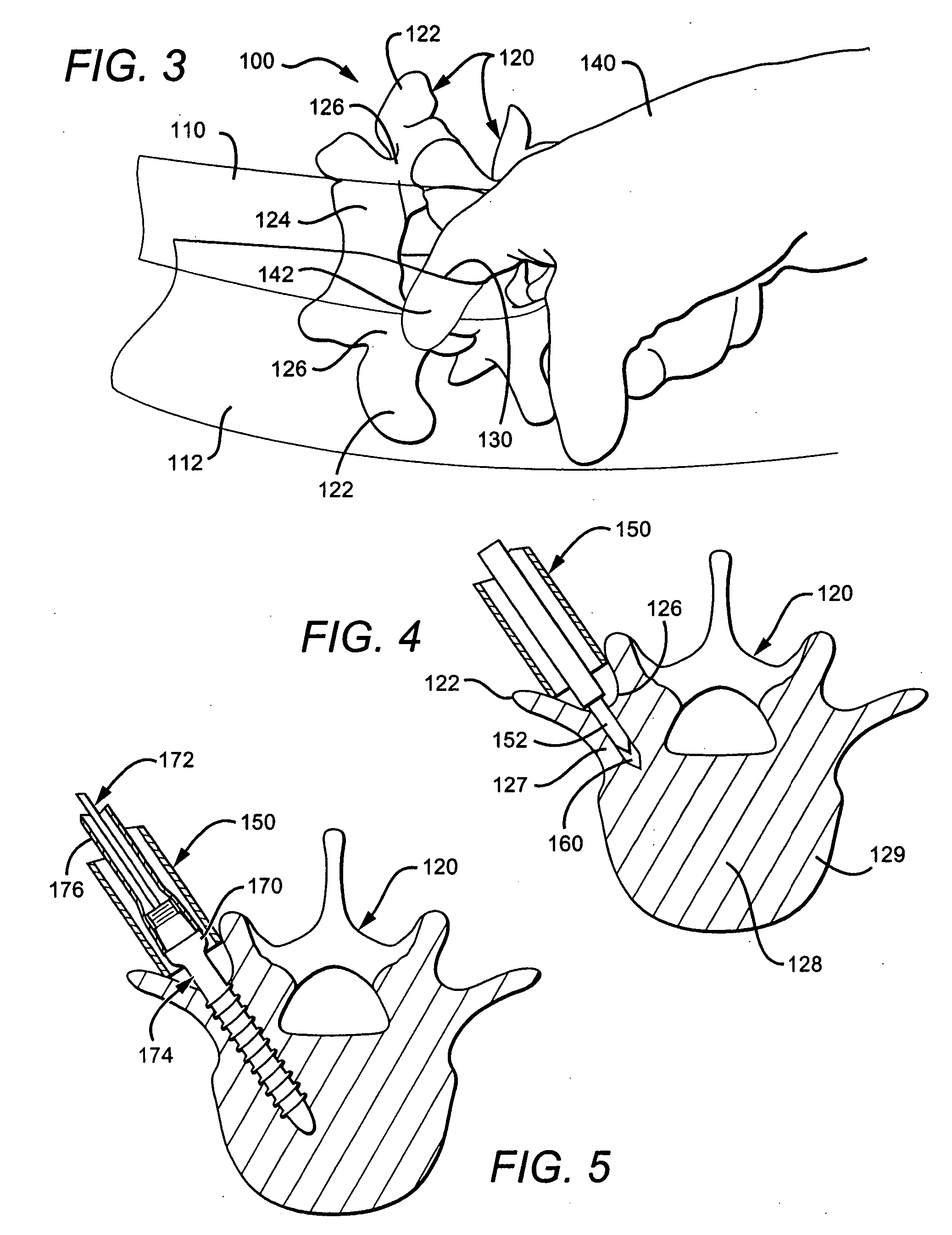 Guided retractor and methods of use