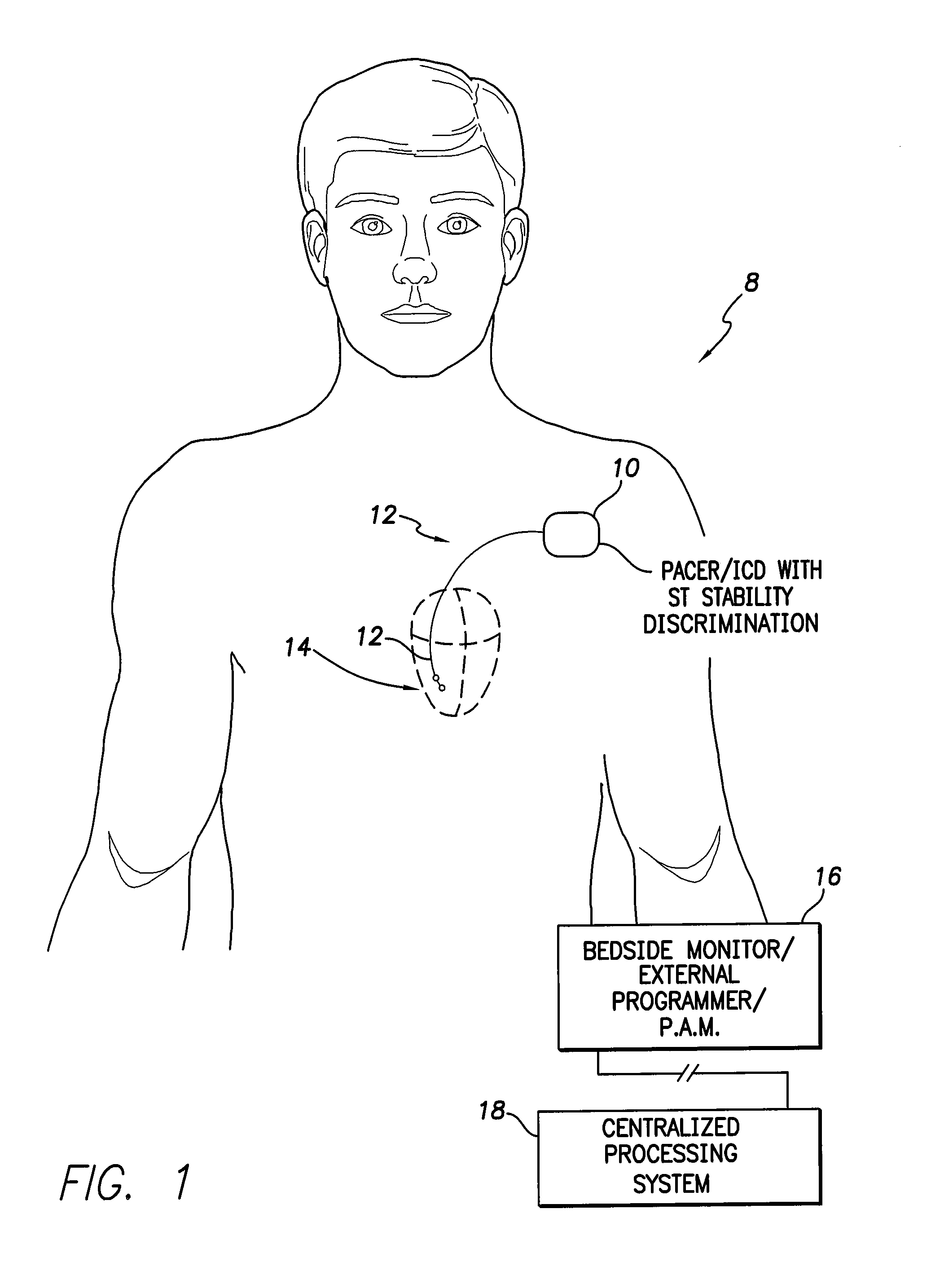Systems and methods for st segment stability discrimination during cardiac ischemia detection for use with implantable medical devices
