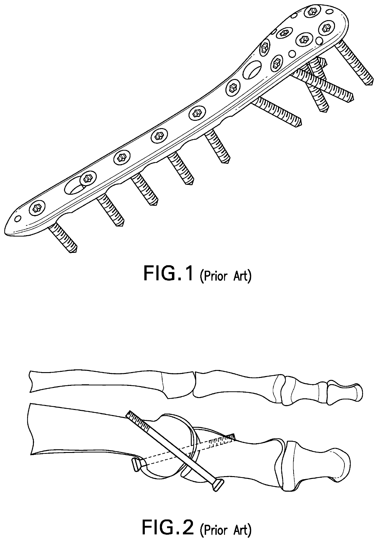 Orthopedic plate with modular peg and compression screw