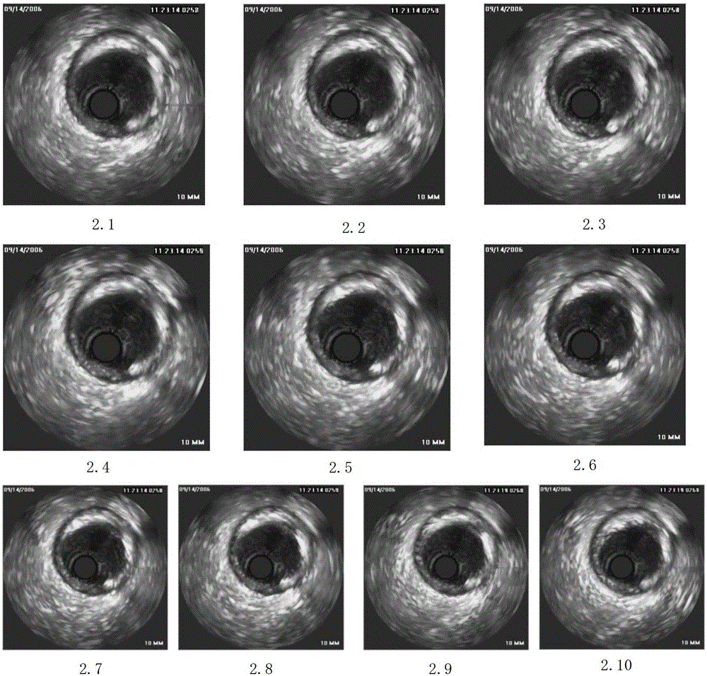 A three-dimensional visualization method of blood vessels based on intravascular ultrasound images