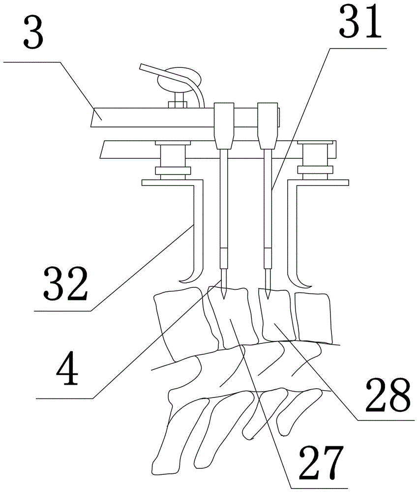 Surgical instrument for treating cervical spine fracture dislocation and operating bed