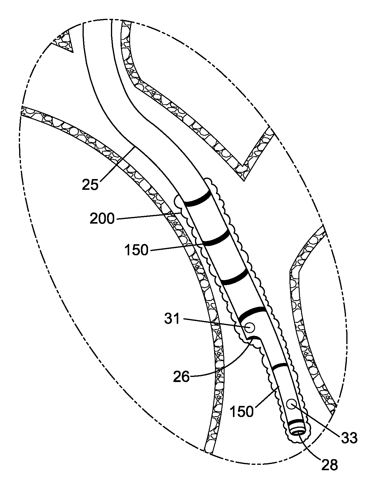 Device and method for the ablation of fibrin sheath formation on a venous catheter