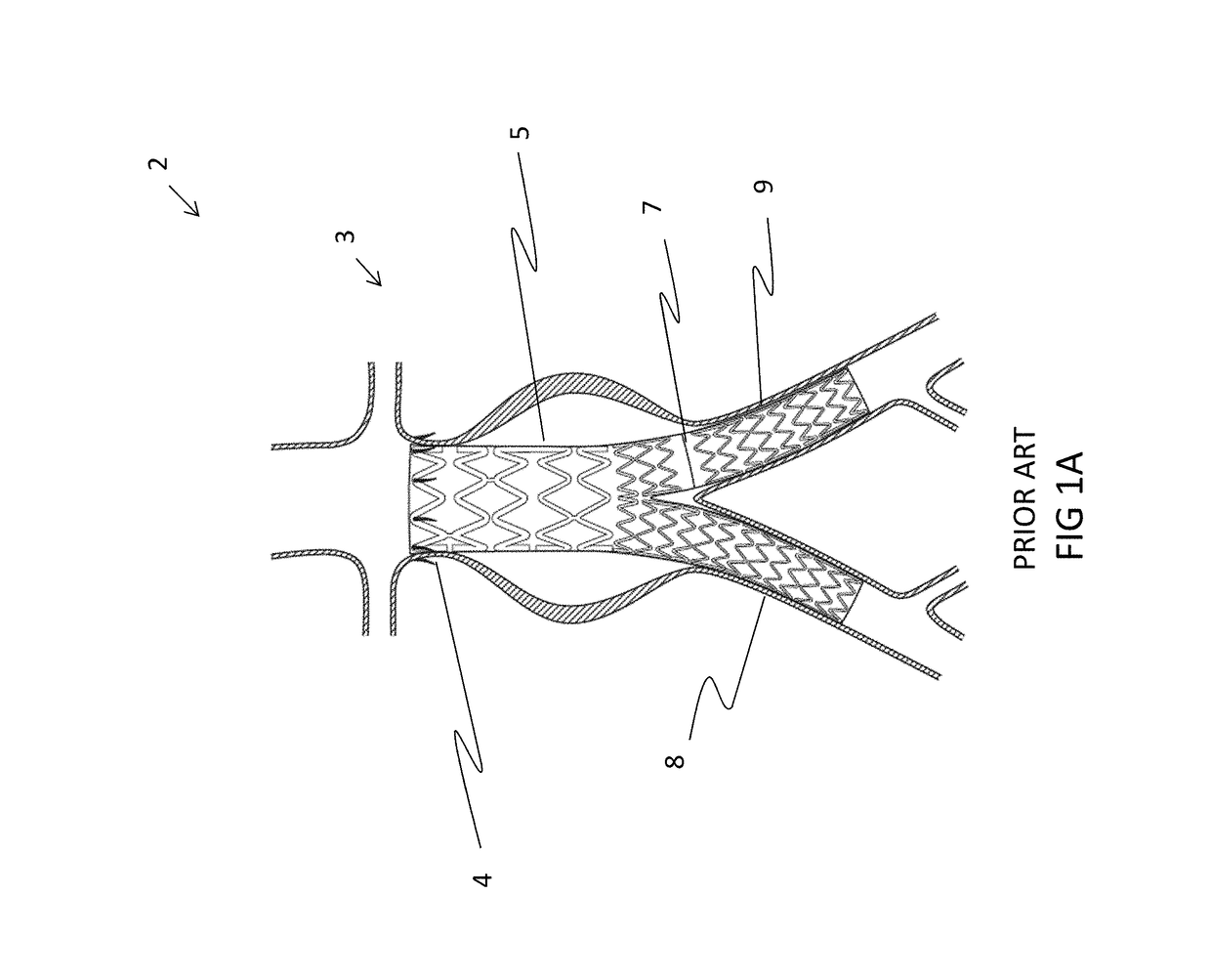 Intravascular bifurication zone implants and crimping and deployment methods thereof
