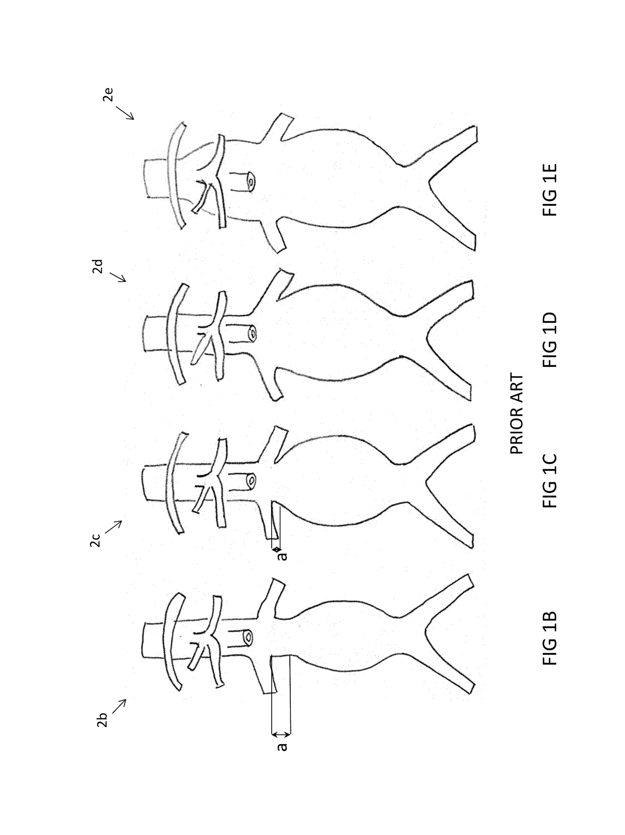 Intravascular bifurication zone implants and crimping and deployment methods thereof