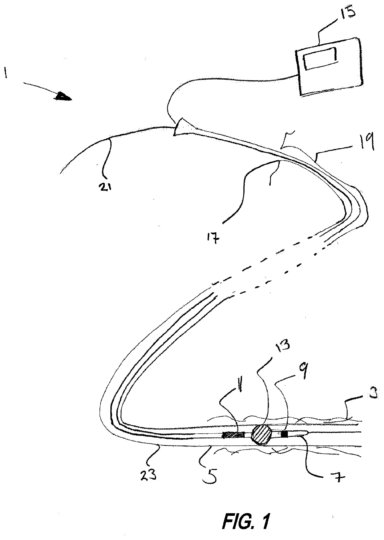 Neurostimulation device for blocking blood flow between electrodes