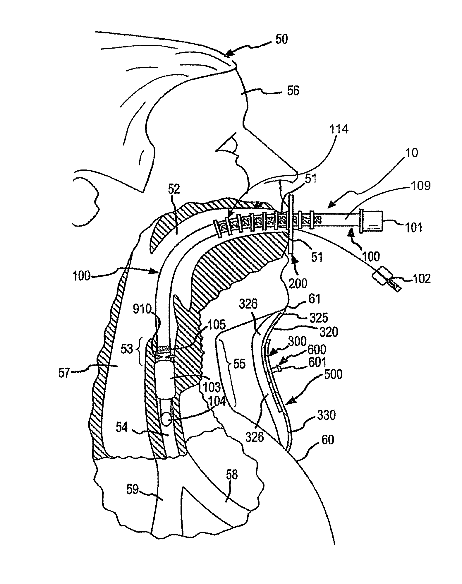Complete airway stabilization system and method