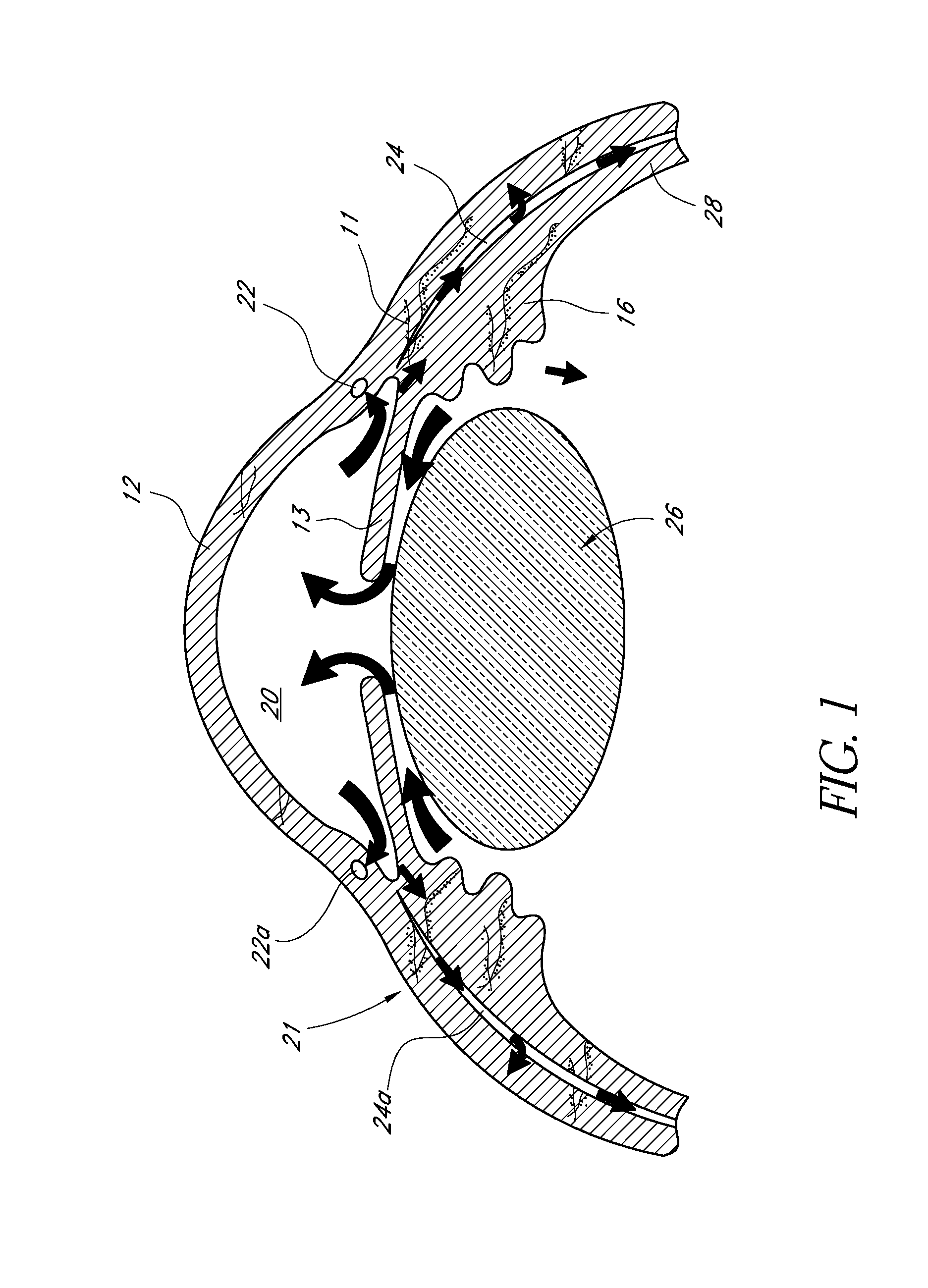 Uveoscleral drug delivery implant and methods for implanting the same