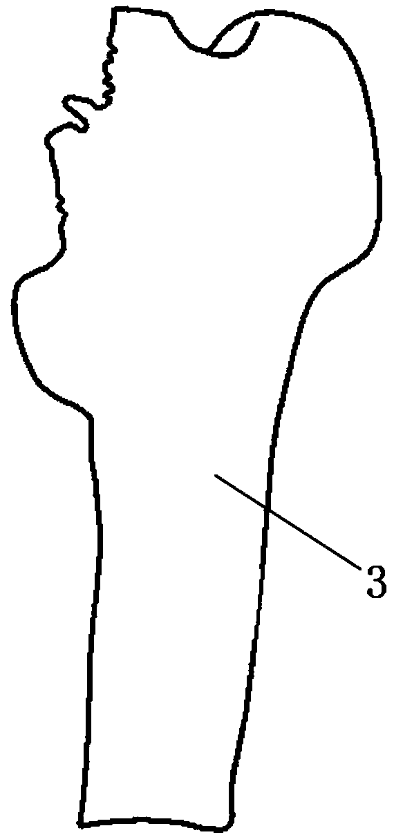 Personal guide device of implanting anteversion angle for femoral stem prosthesis