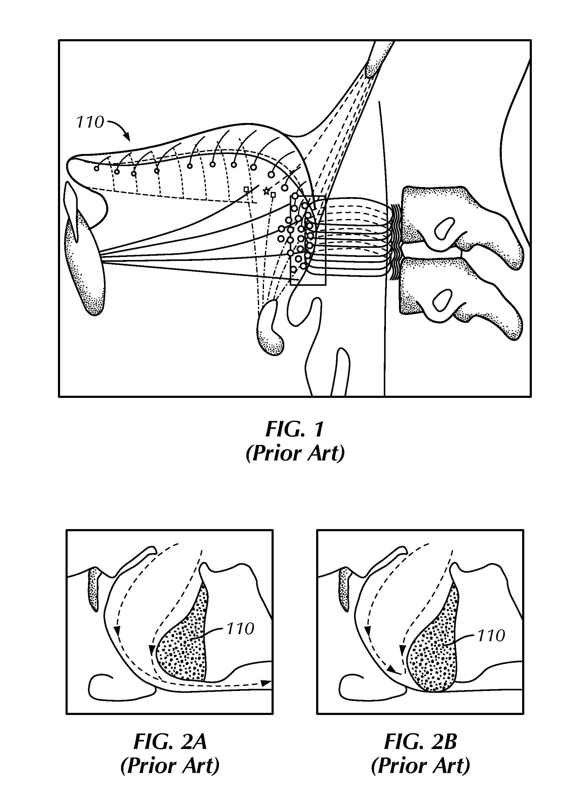 System For Stimulating A Hypoglossal Nerve For Controlling The Position Of A Patient's Tongue