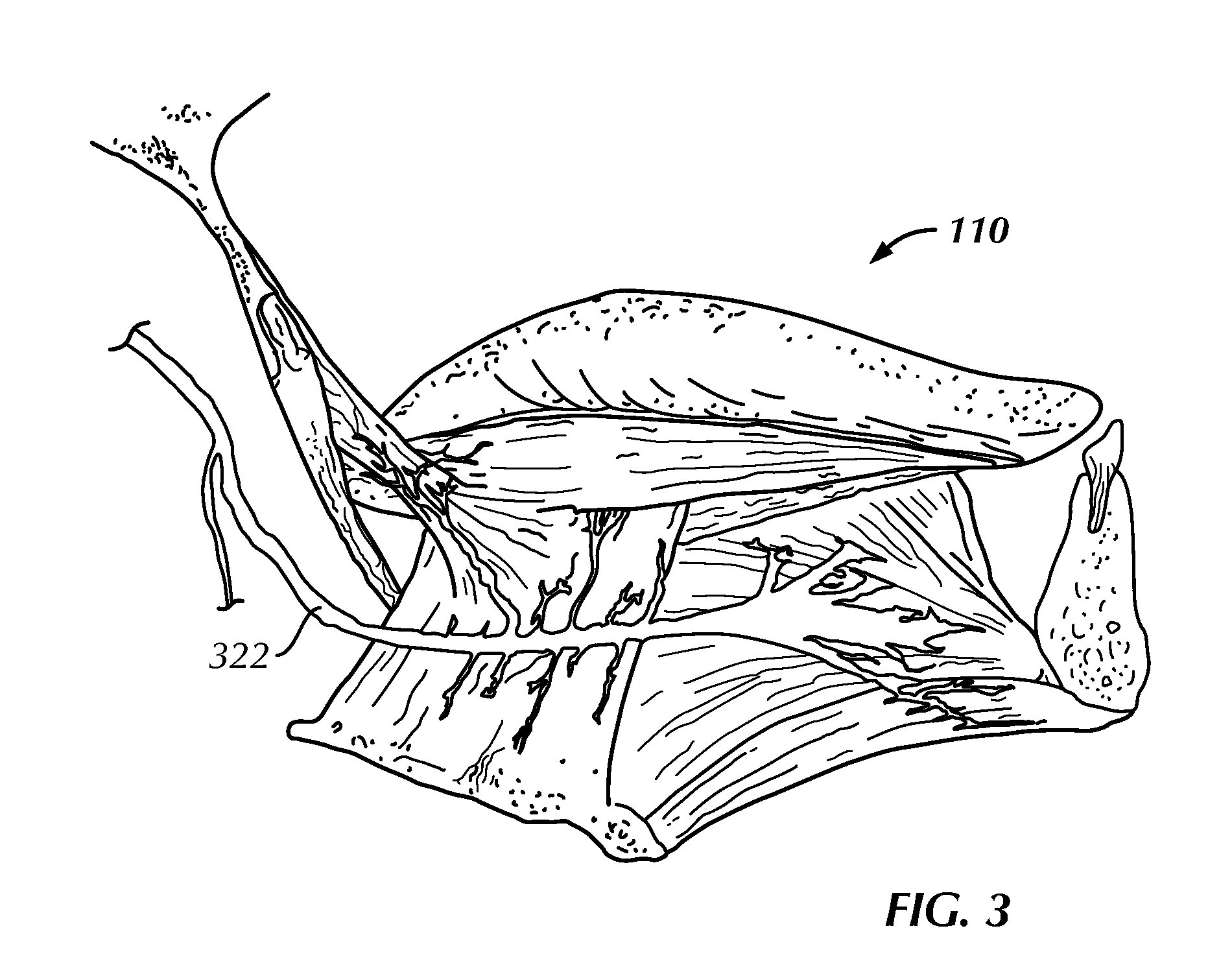 System For Stimulating A Hypoglossal Nerve For Controlling The Position Of A Patient's Tongue