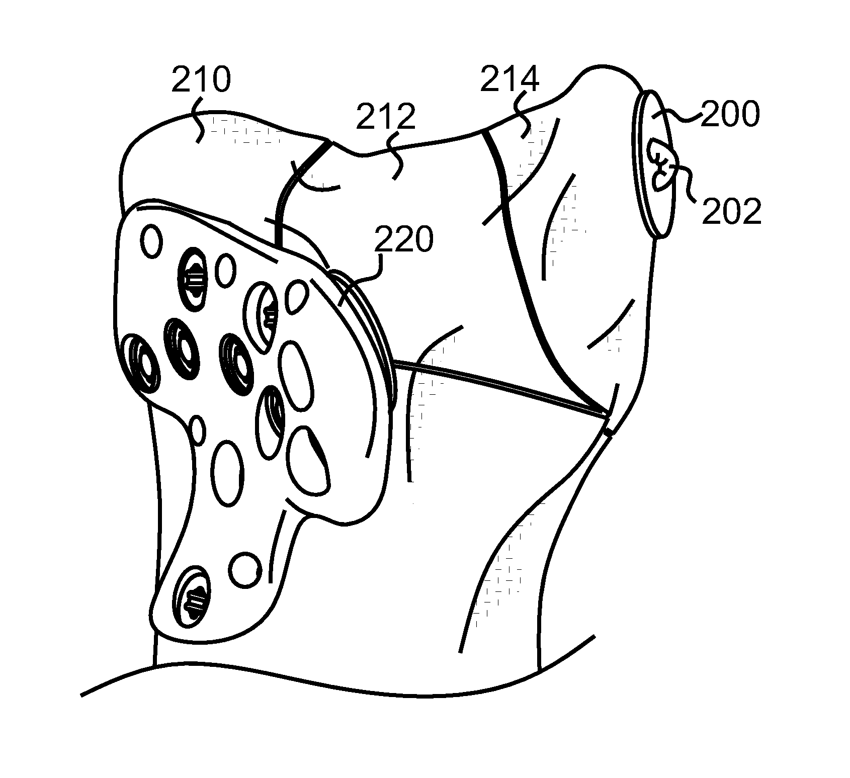 Atraumatic fastener and bone stabilization system and method of use