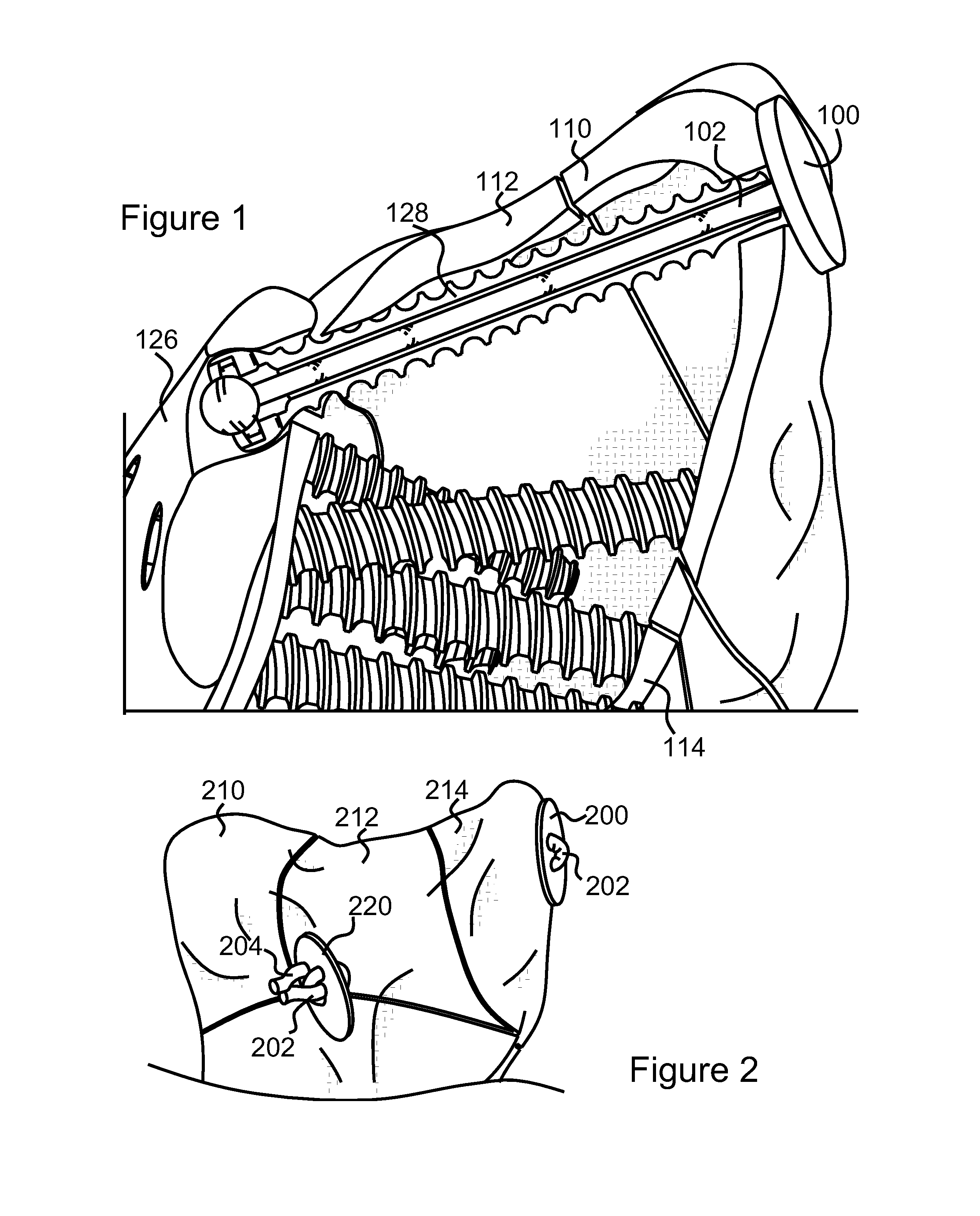 Atraumatic fastener and bone stabilization system and method of use