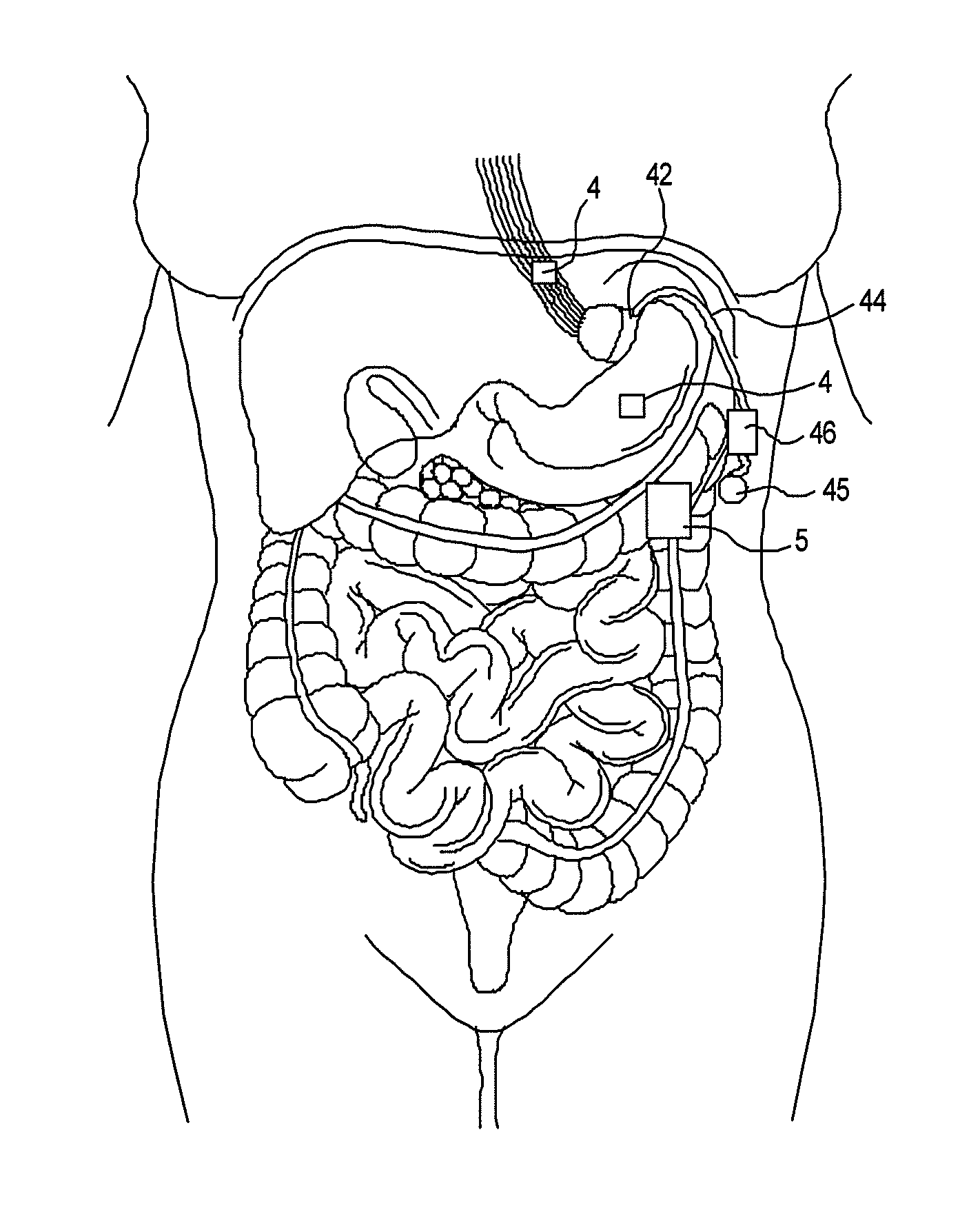 Artificial gastric valve