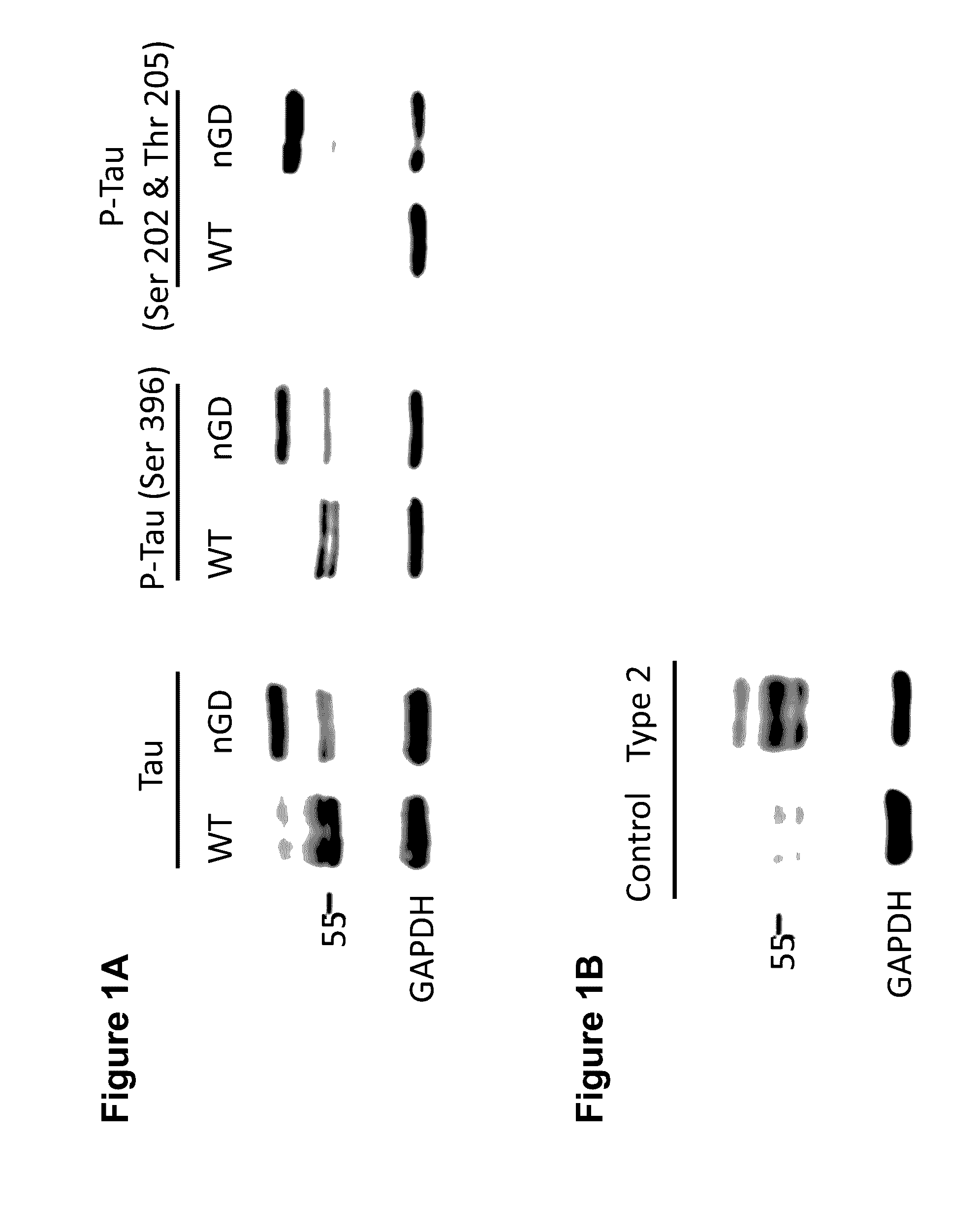 Marker of neuropathic gaucher's disease and methods of use thereof