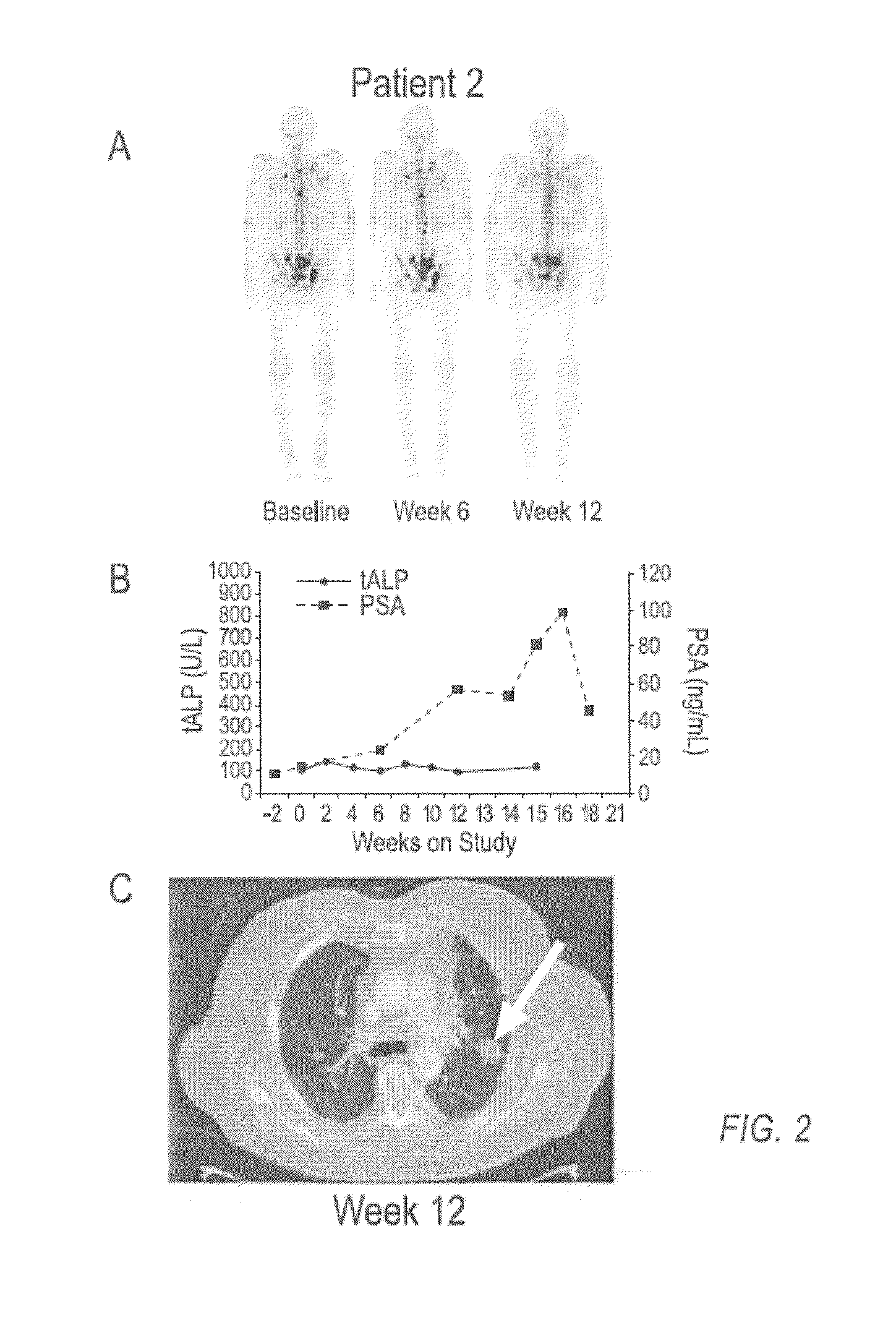 Method of Treating Cancer and Bone Cancer Pain