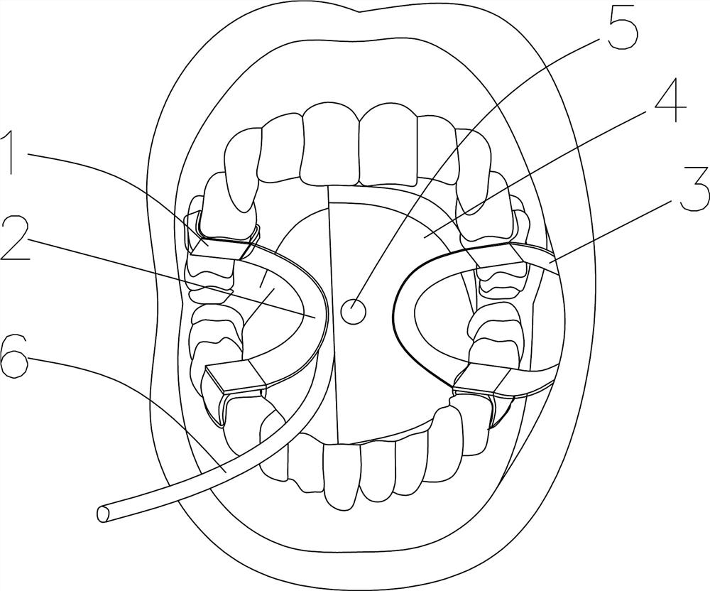 Auxiliary fixator for maxillofacial surgery