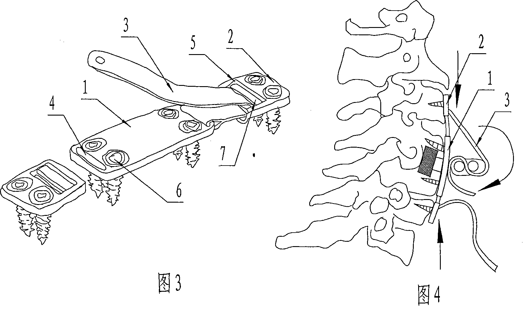 System for fixing anterior cervical and capable of preventing overcompensation movement