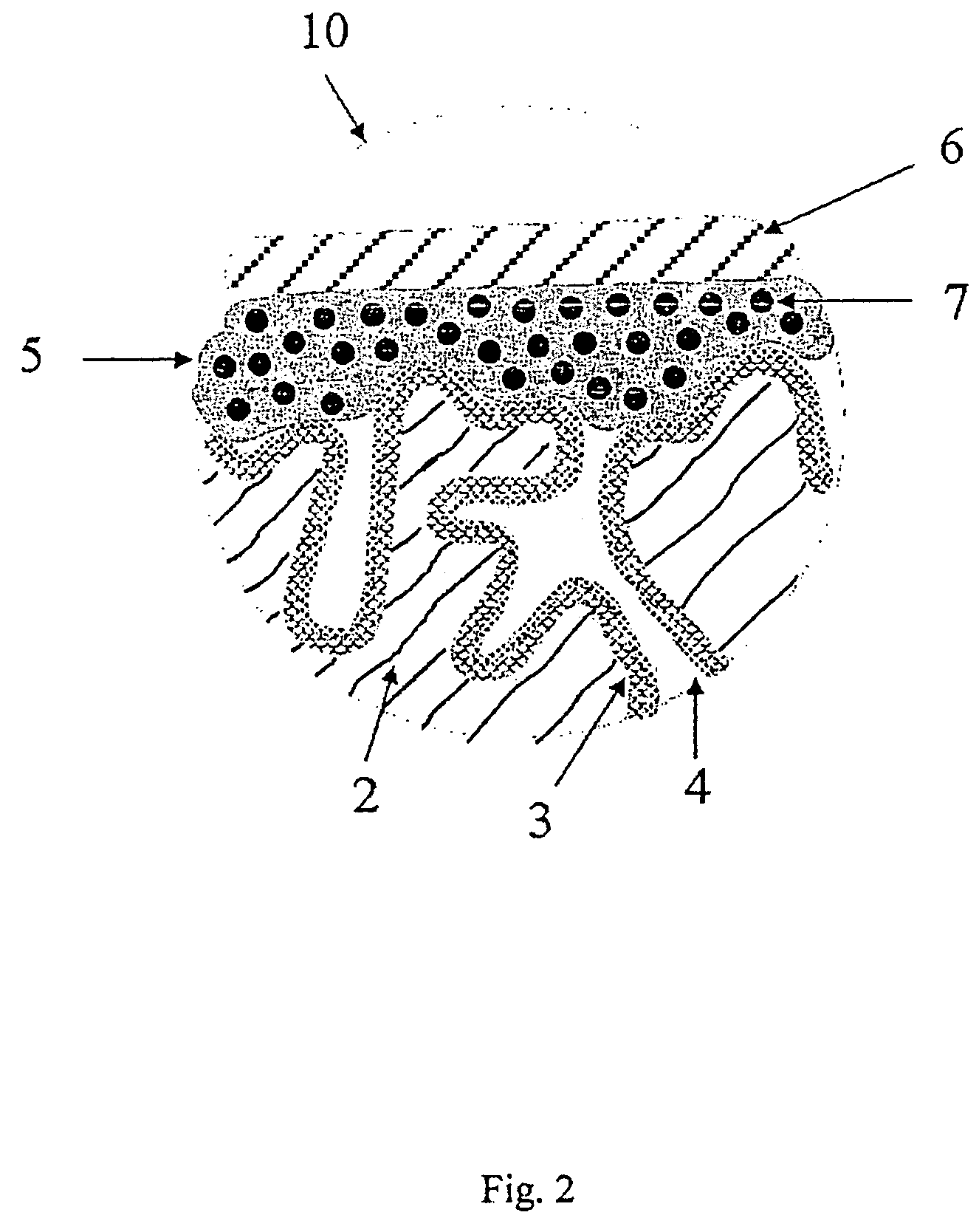 Electrolytic capacitors with a polymeric outer layer and process for the production thereof