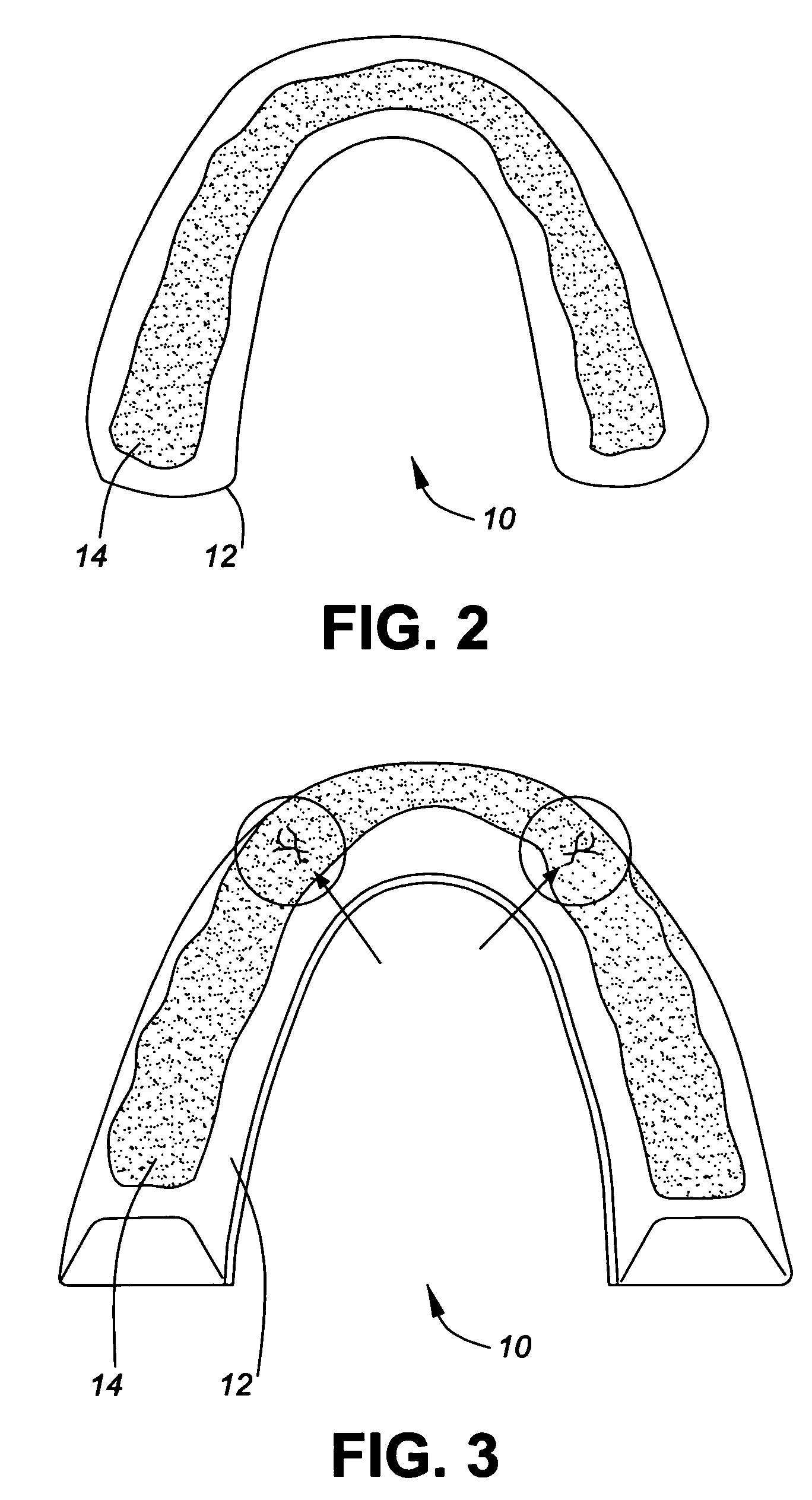 Bruxism appliance and method of forming