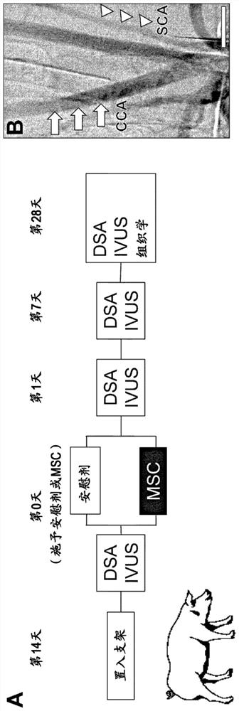 Pharmaceutical composition for preventing in-stent restenosis