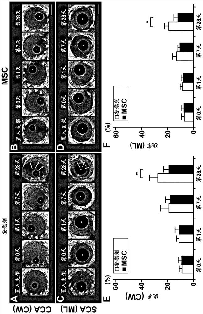 Pharmaceutical composition for preventing in-stent restenosis