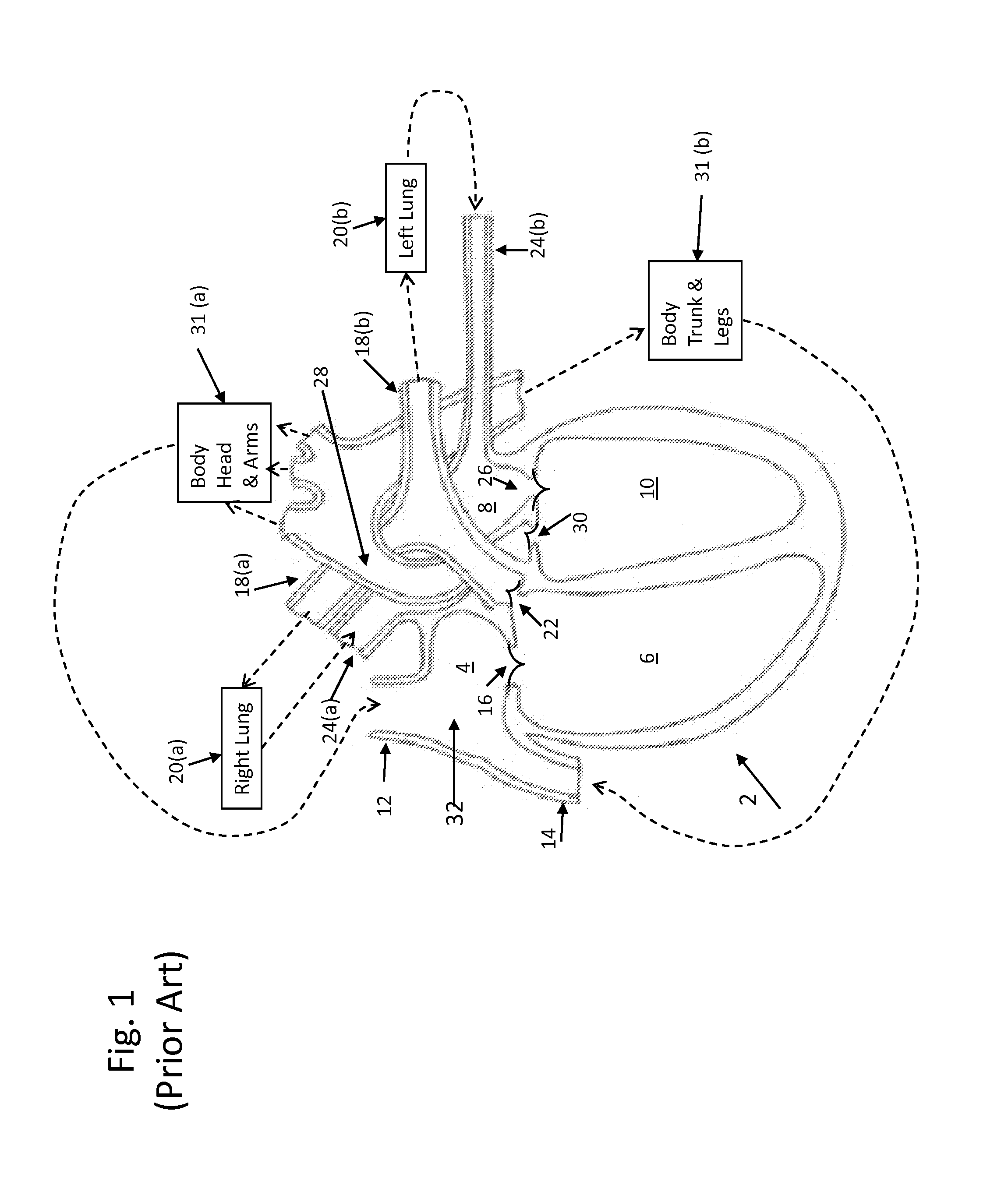 System and Method For Monitoring Cardiac Blood Flow Balance Between The Right and Left Heart Chambers