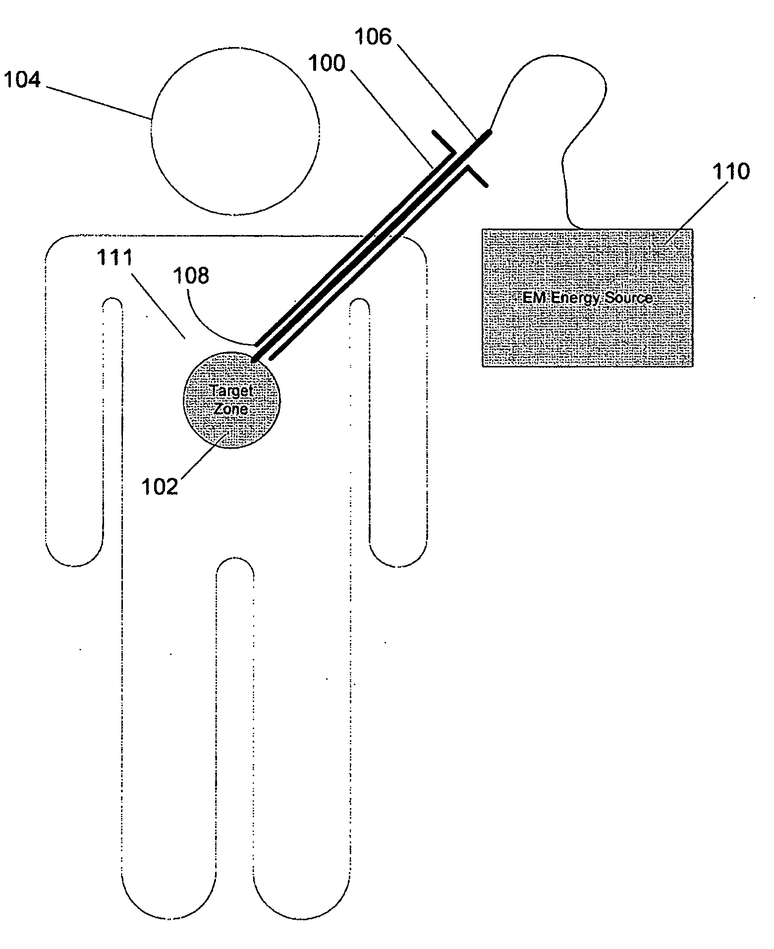 Heating via microwave and millimeter-wave transmission using a hypodermic needle
