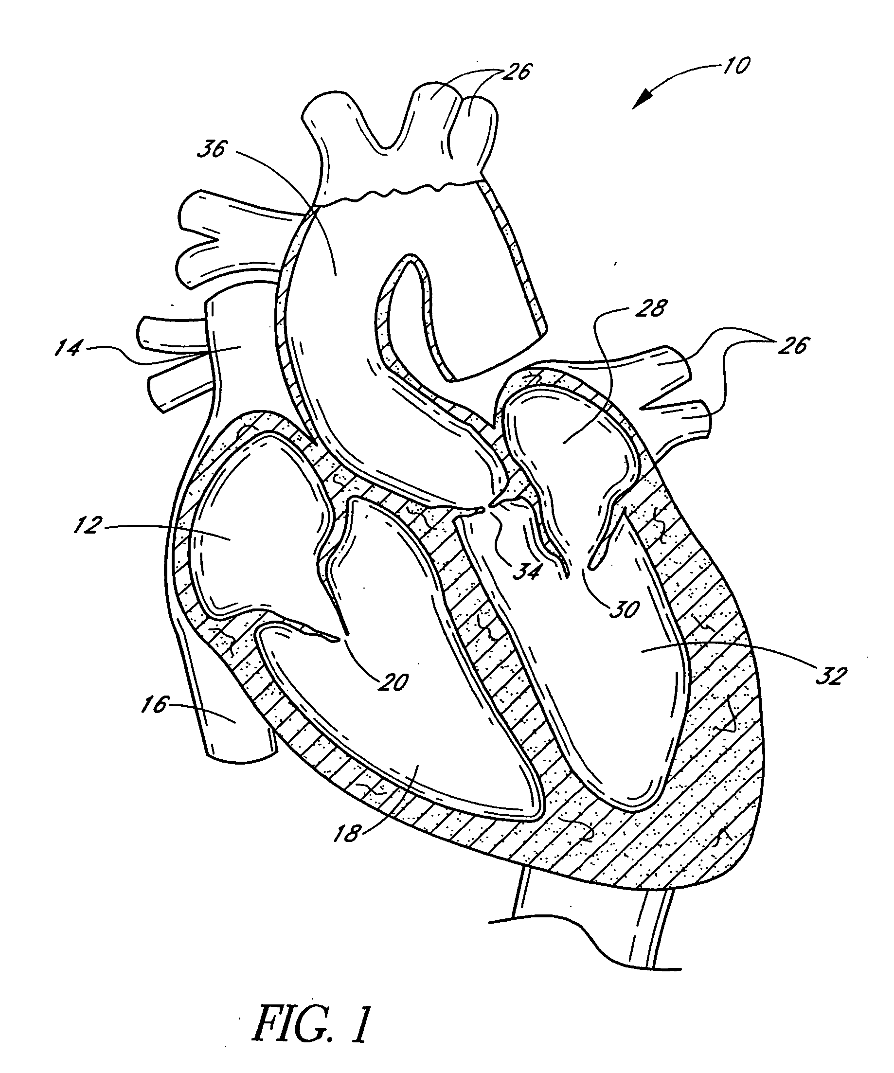 Translumenally implantable heart valve with multiple chamber formed in place support